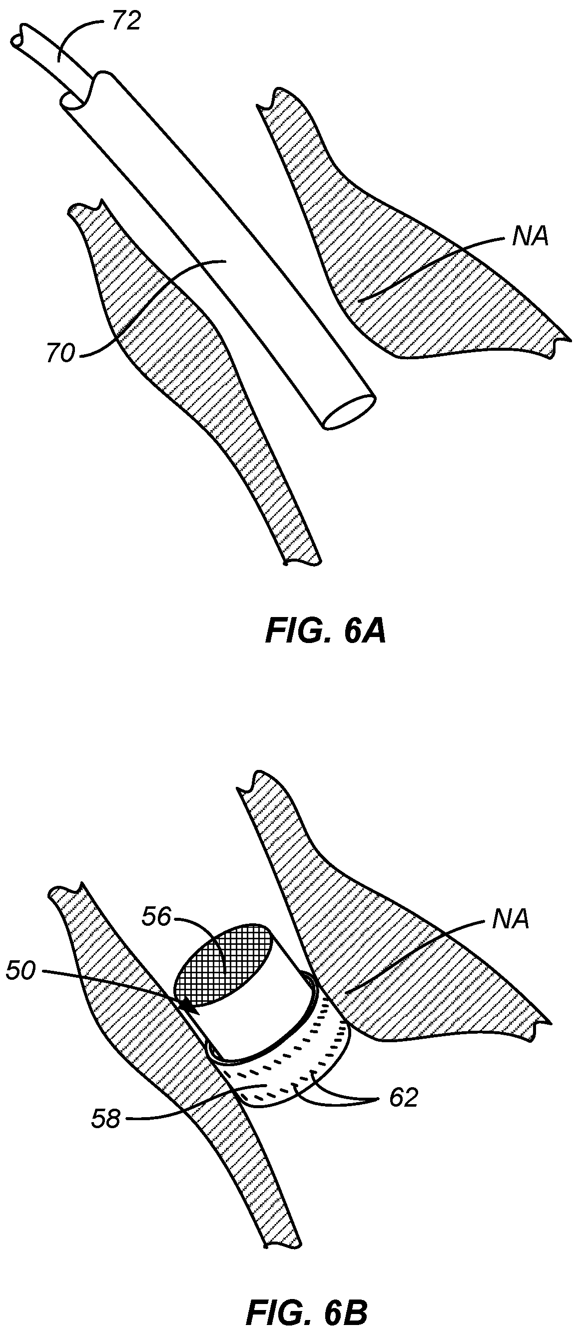 Patent US12318284 Figure 6 – Endovascular prosthetic heart valve replacement