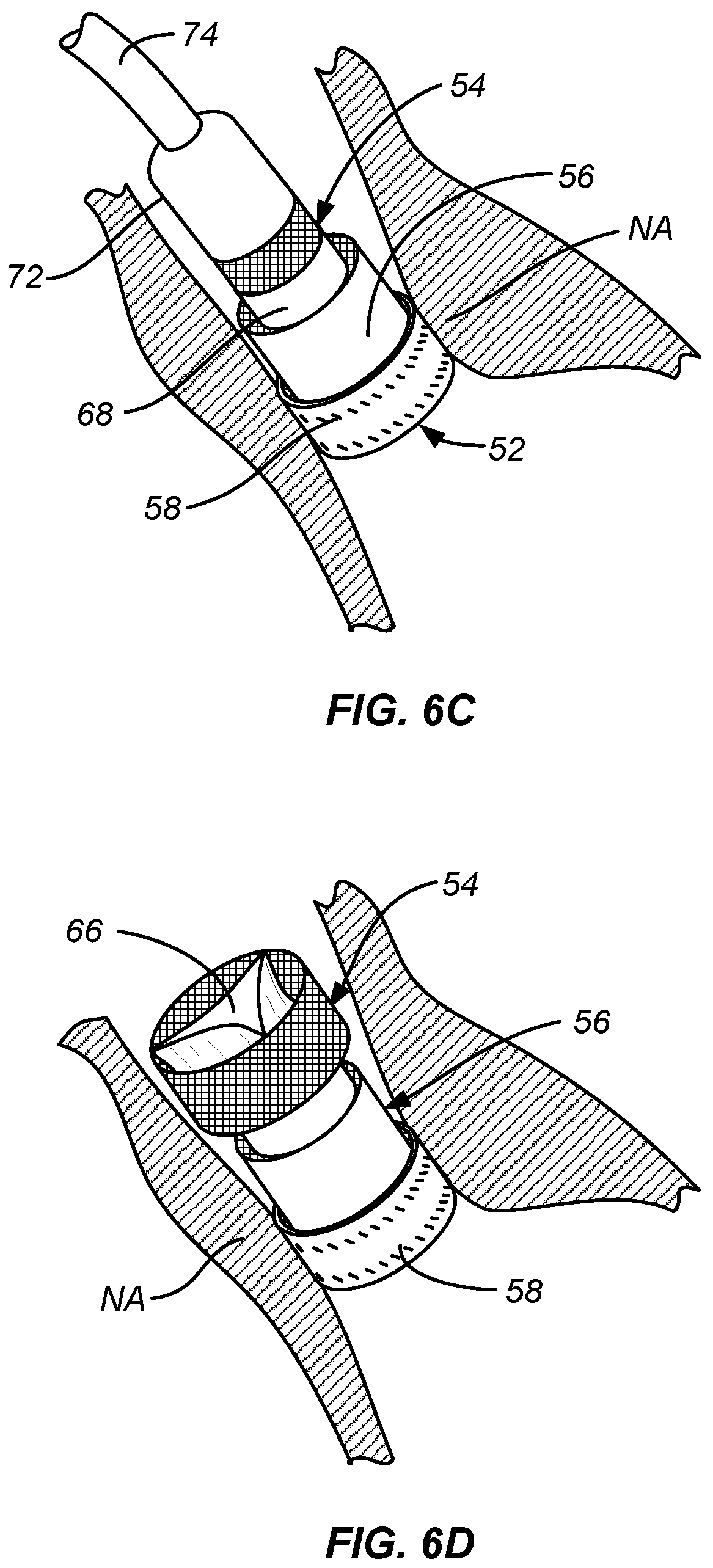 Patent US12318284 Figure 7 – Endovascular prosthetic heart valve replacement