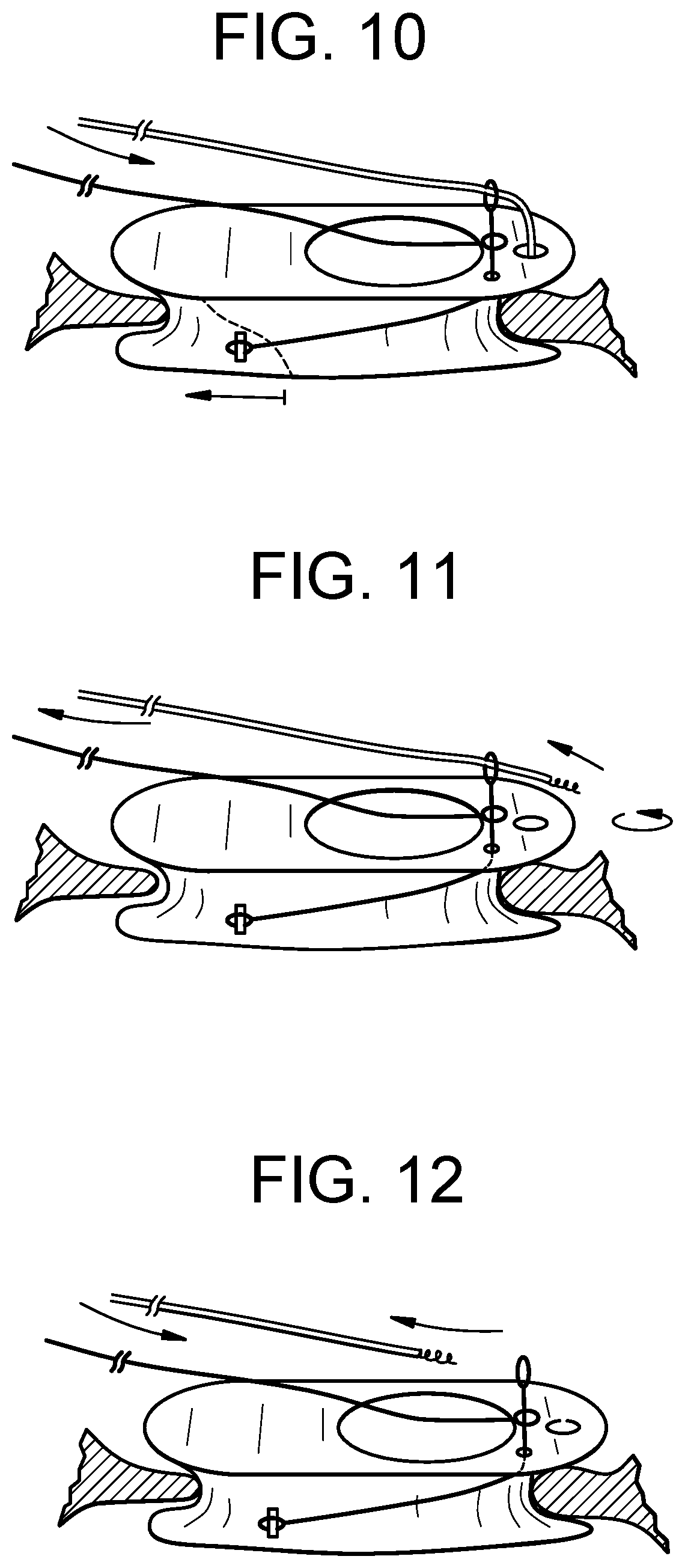 Patent US12318286 Figure 5 – Cinch device and method for deployment of a side-delivered prosthetic heart valve in a native annulus