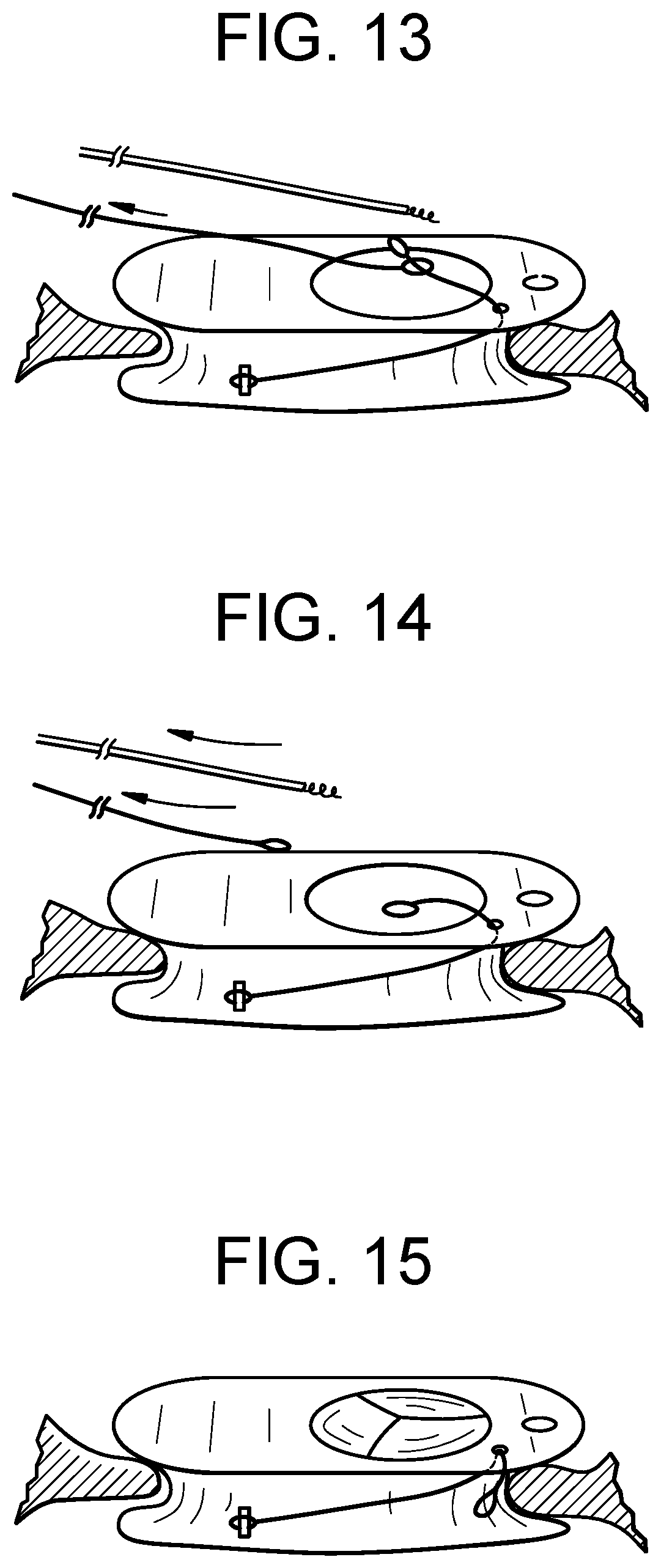 Patent US12318286 Figure 6 – Cinch device and method for deployment of a side-delivered prosthetic heart valve in a native annulus