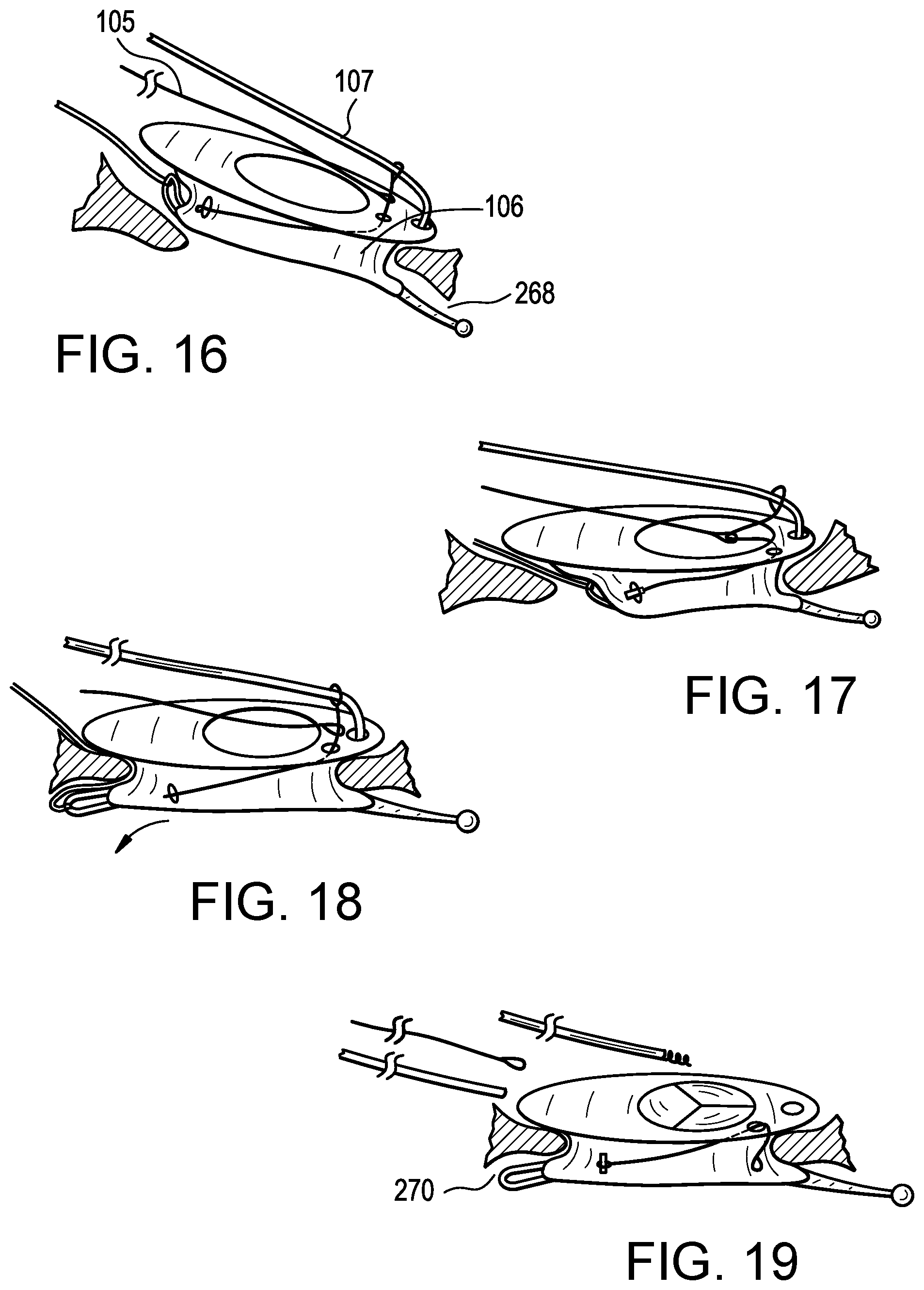 Patent US12318286 Figure 7 – Cinch device and method for deployment of a side-delivered prosthetic heart valve in a native annulus