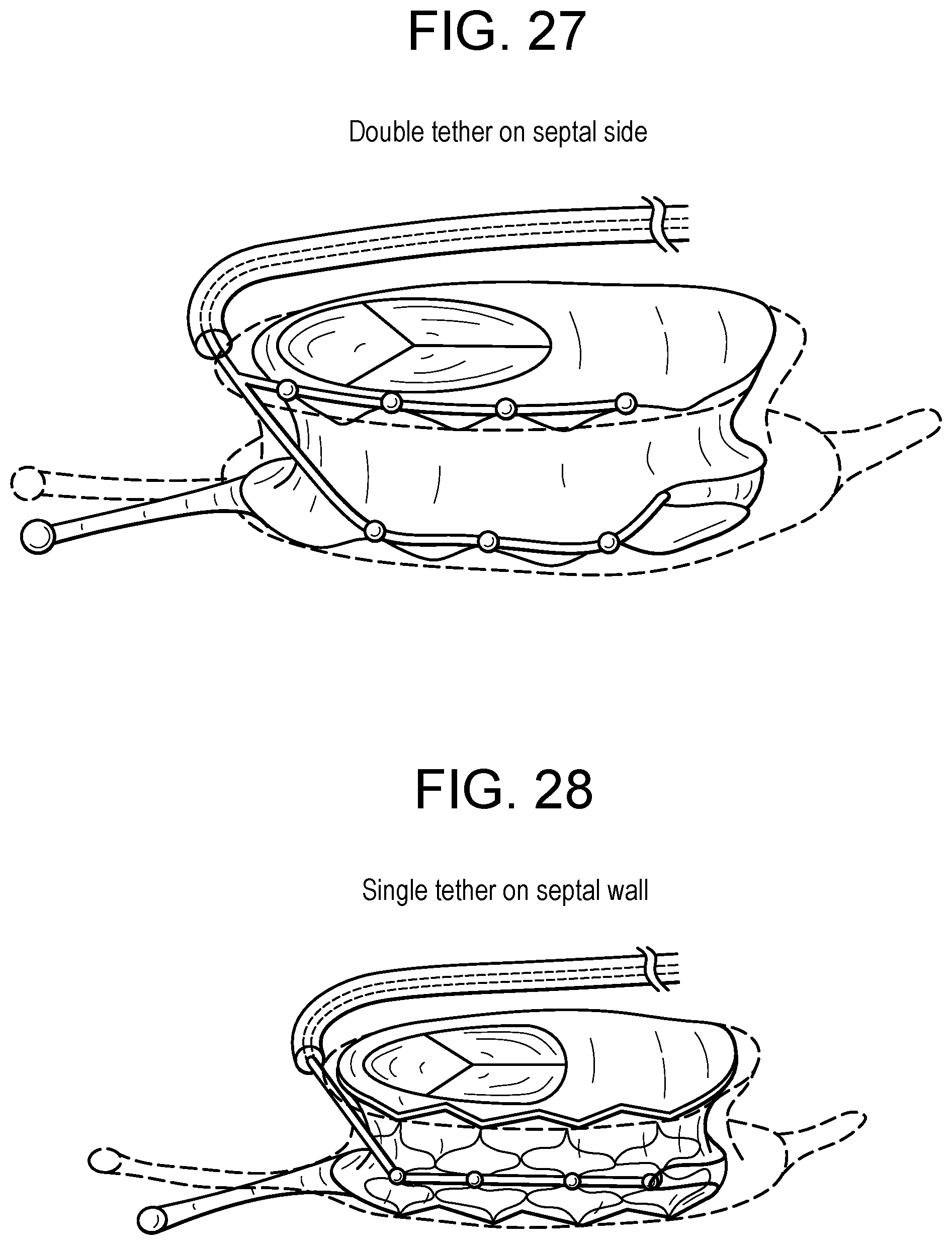 Patent US12318286 Figure 11 – Cinch device and method for deployment of a side-delivered prosthetic heart valve in a native annulus