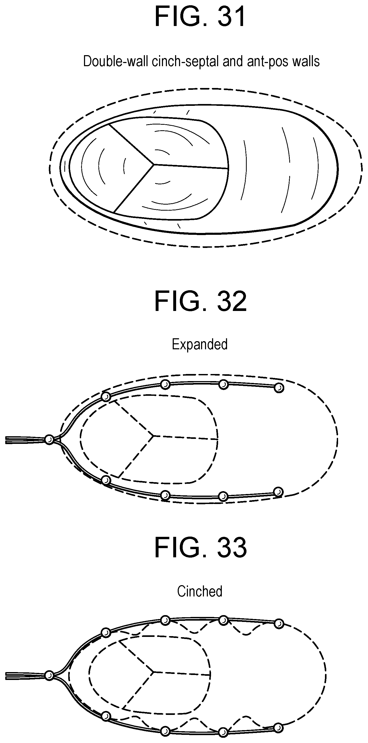 Patent US12318286 Figure 13 – Cinch device and method for deployment of a side-delivered prosthetic heart valve in a native annulus
