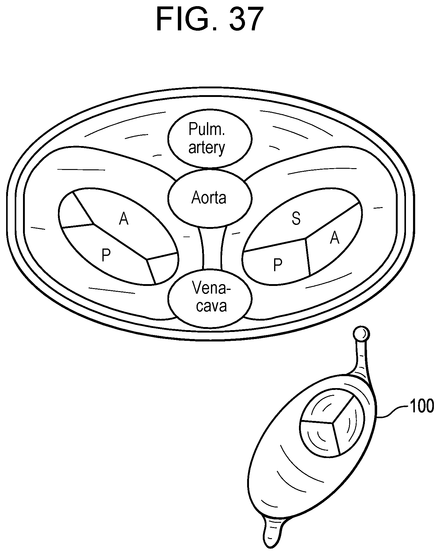 Patent US12318286 Figure 15 – Cinch device and method for deployment of a side-delivered prosthetic heart valve in a native annulus