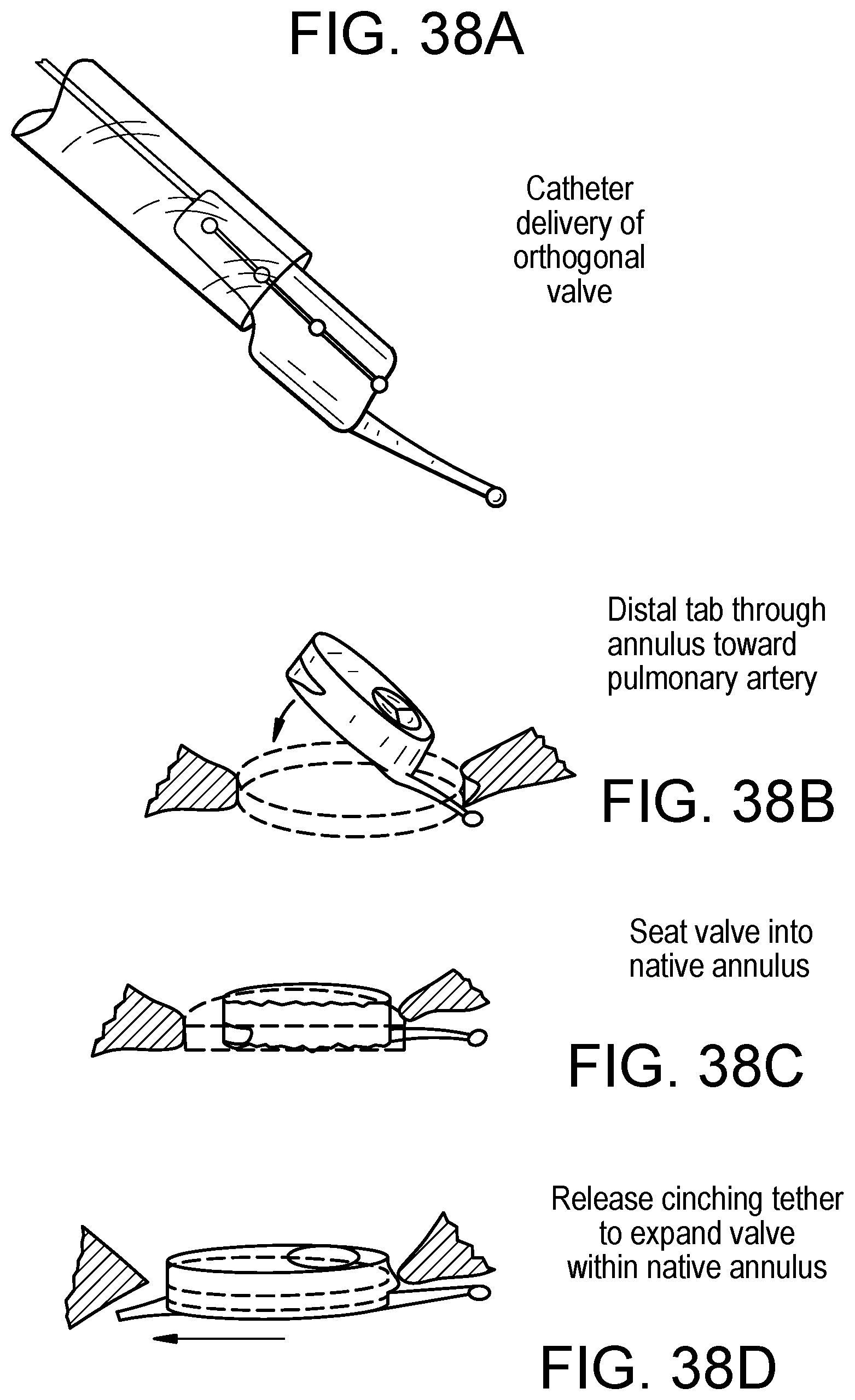 Patent US12318286 Figure 16 – Cinch device and method for deployment of a side-delivered prosthetic heart valve in a native annulus