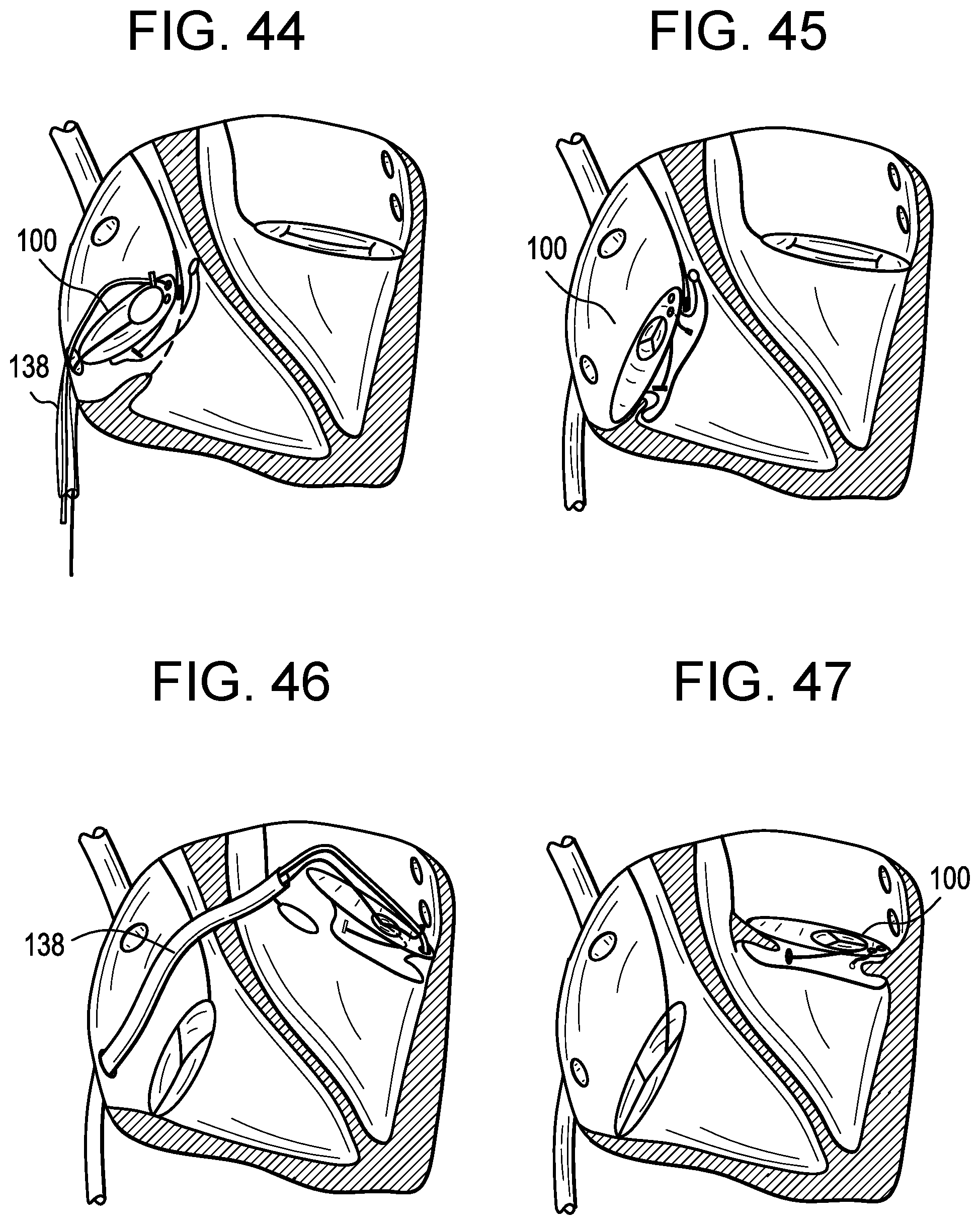 Patent US12318286 Figure 18 – Cinch device and method for deployment of a side-delivered prosthetic heart valve in a native annulus