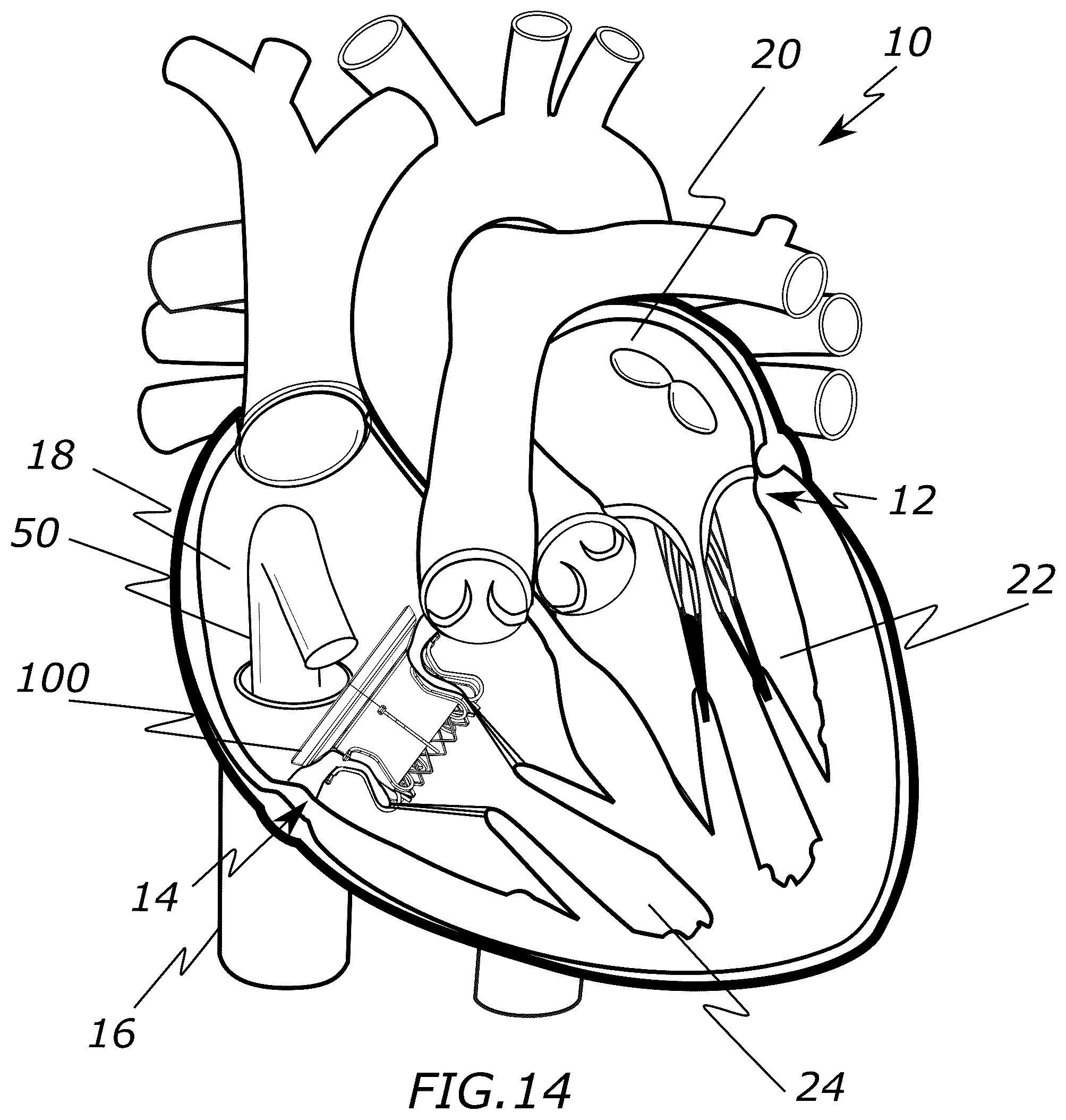Patent US12318287 Figure 7 – Prosthetic heart valve, systems, and methods