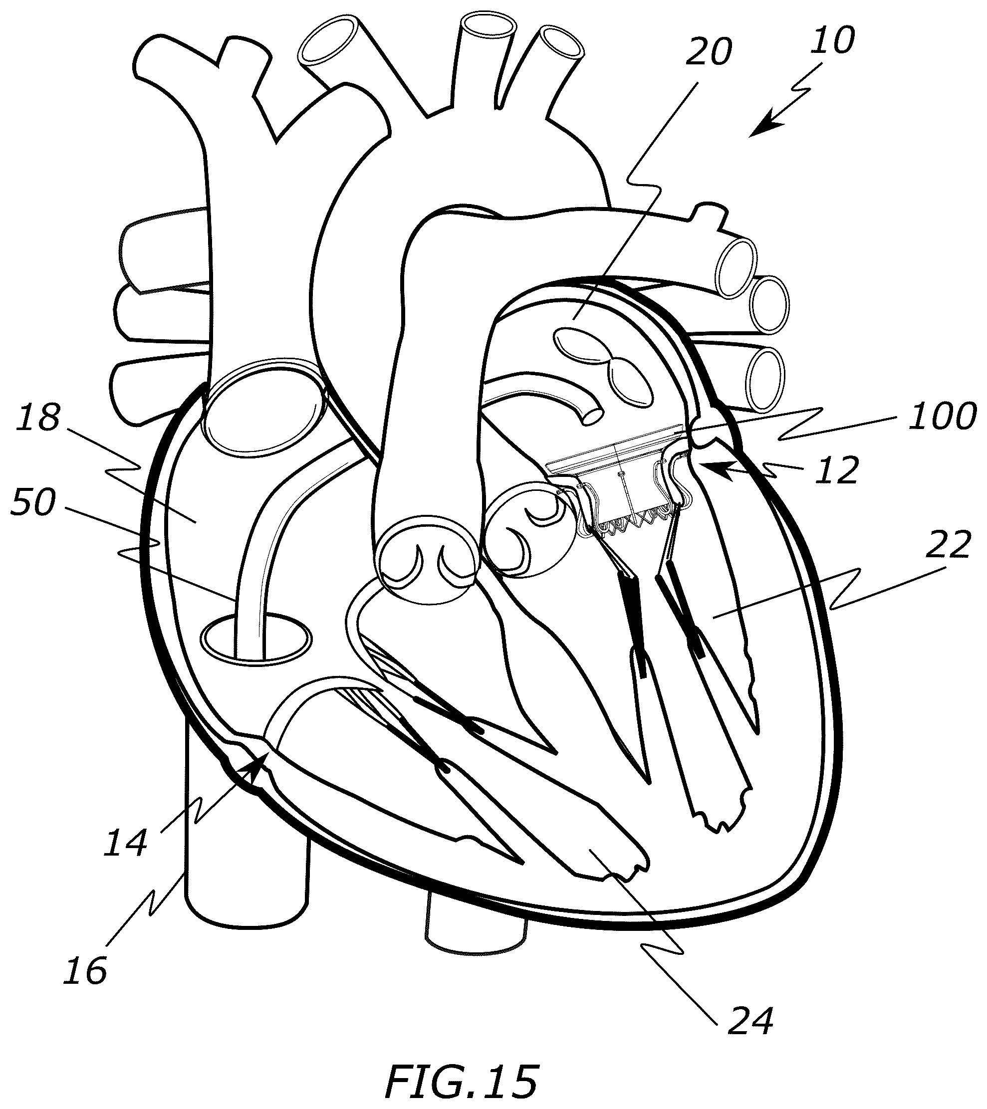 Patent US12318287 Figure 8 – Prosthetic heart valve, systems, and methods