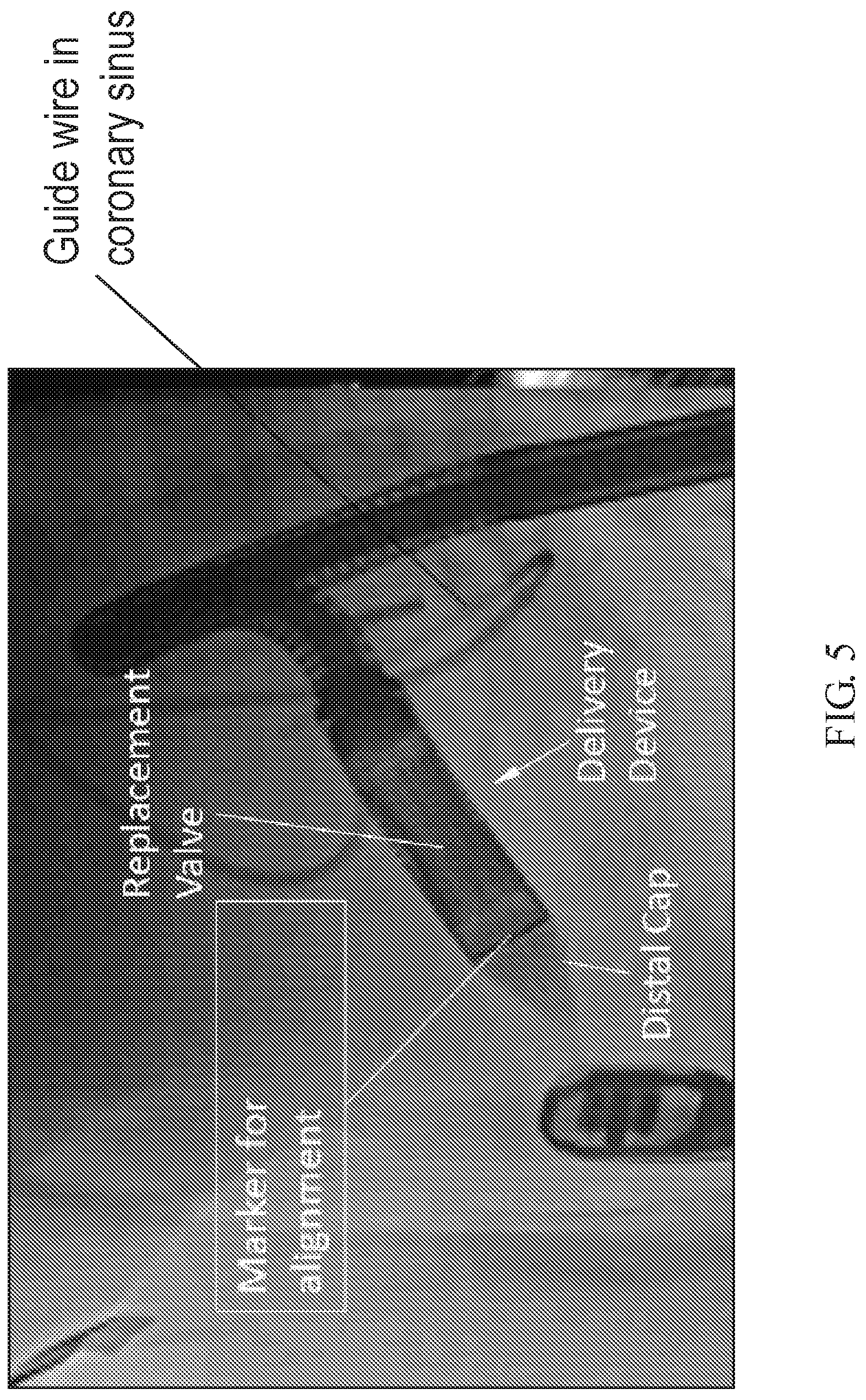 Patent US12318288 Figure 6 – Insert for distal end cap