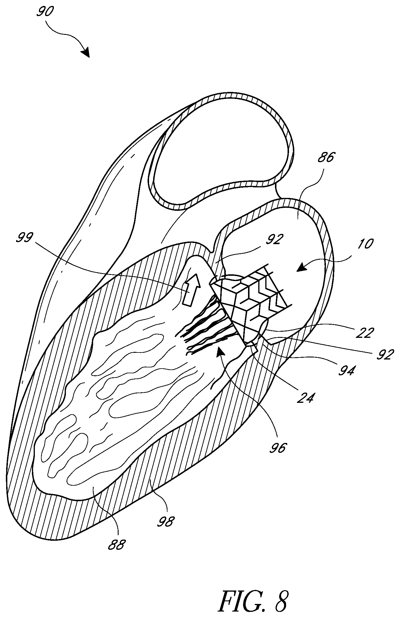Patent US12318290 Figure 13 – Replacement heart valves, delivery devices and methods