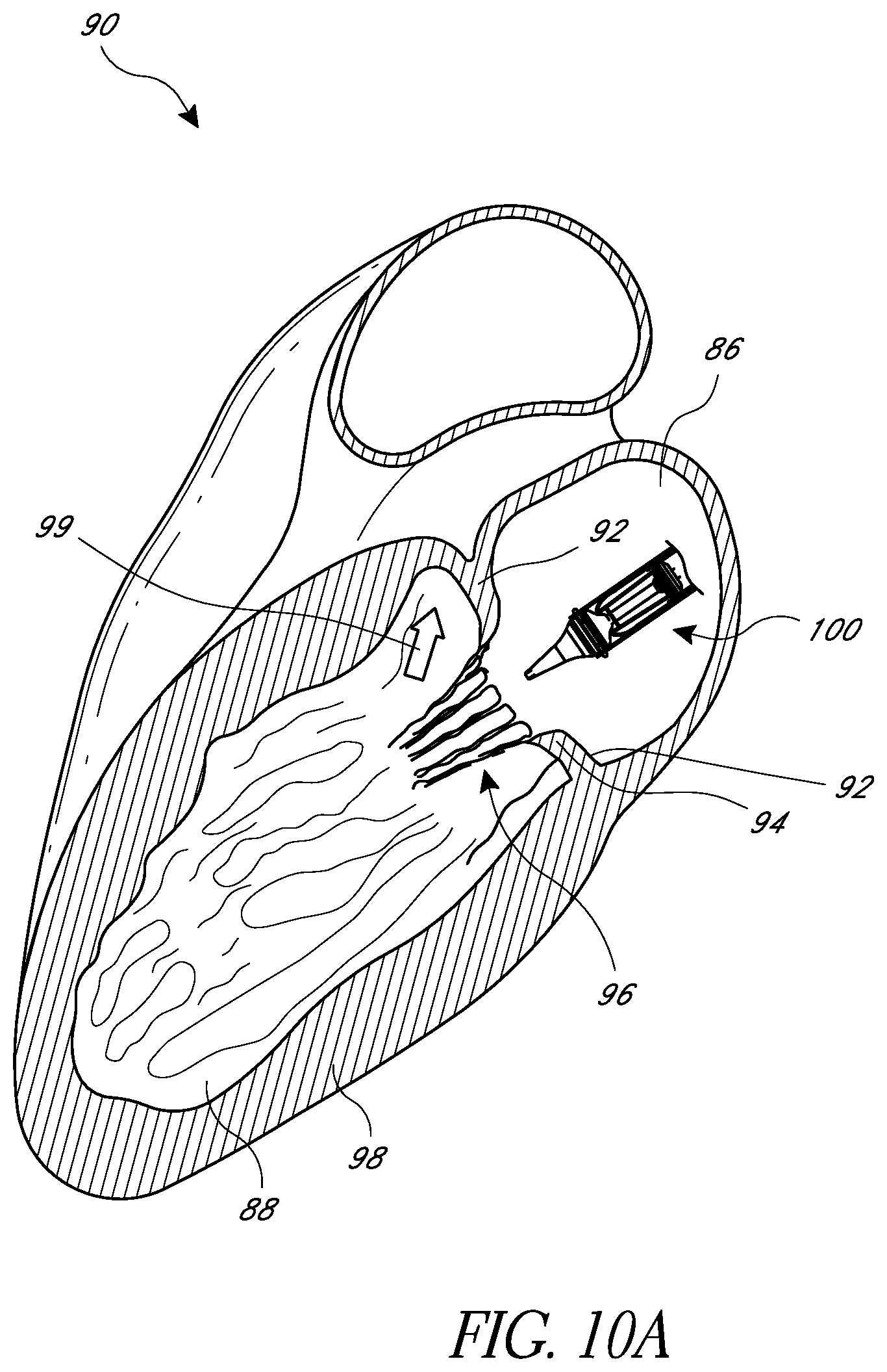 Patent US12318290 Figure 16 – Replacement heart valves, delivery devices and methods