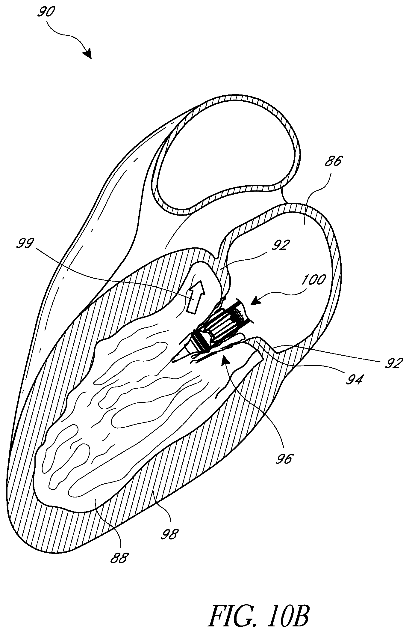 Patent US12318290 Figure 17 – Replacement heart valves, delivery devices and methods