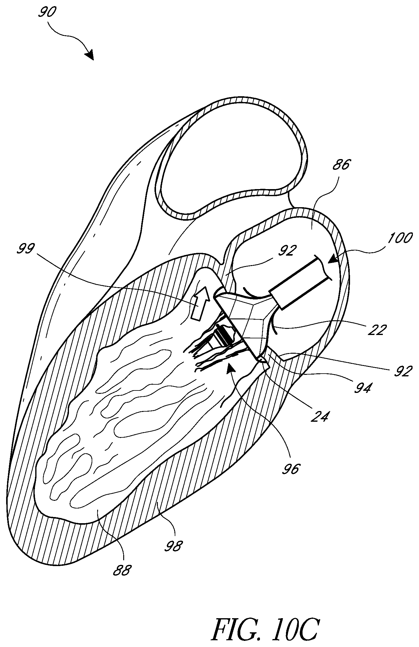 Patent US12318290 Figure 18 – Replacement heart valves, delivery devices and methods