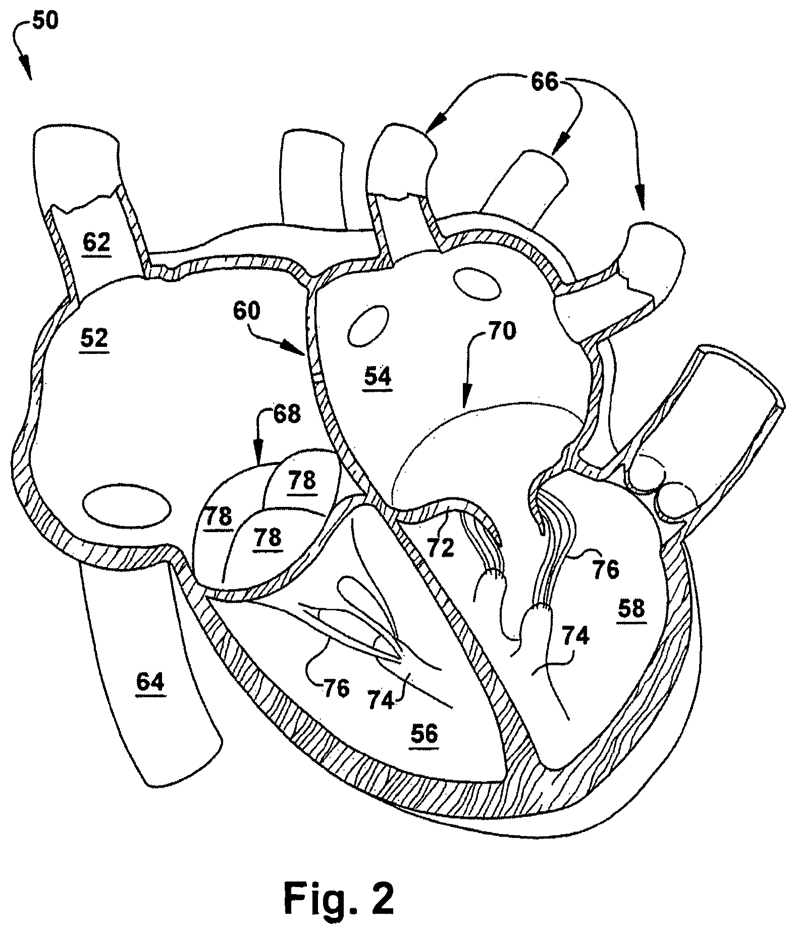 Patent US12318291 Figure 2 – Method for implanting a cardiovascular valve