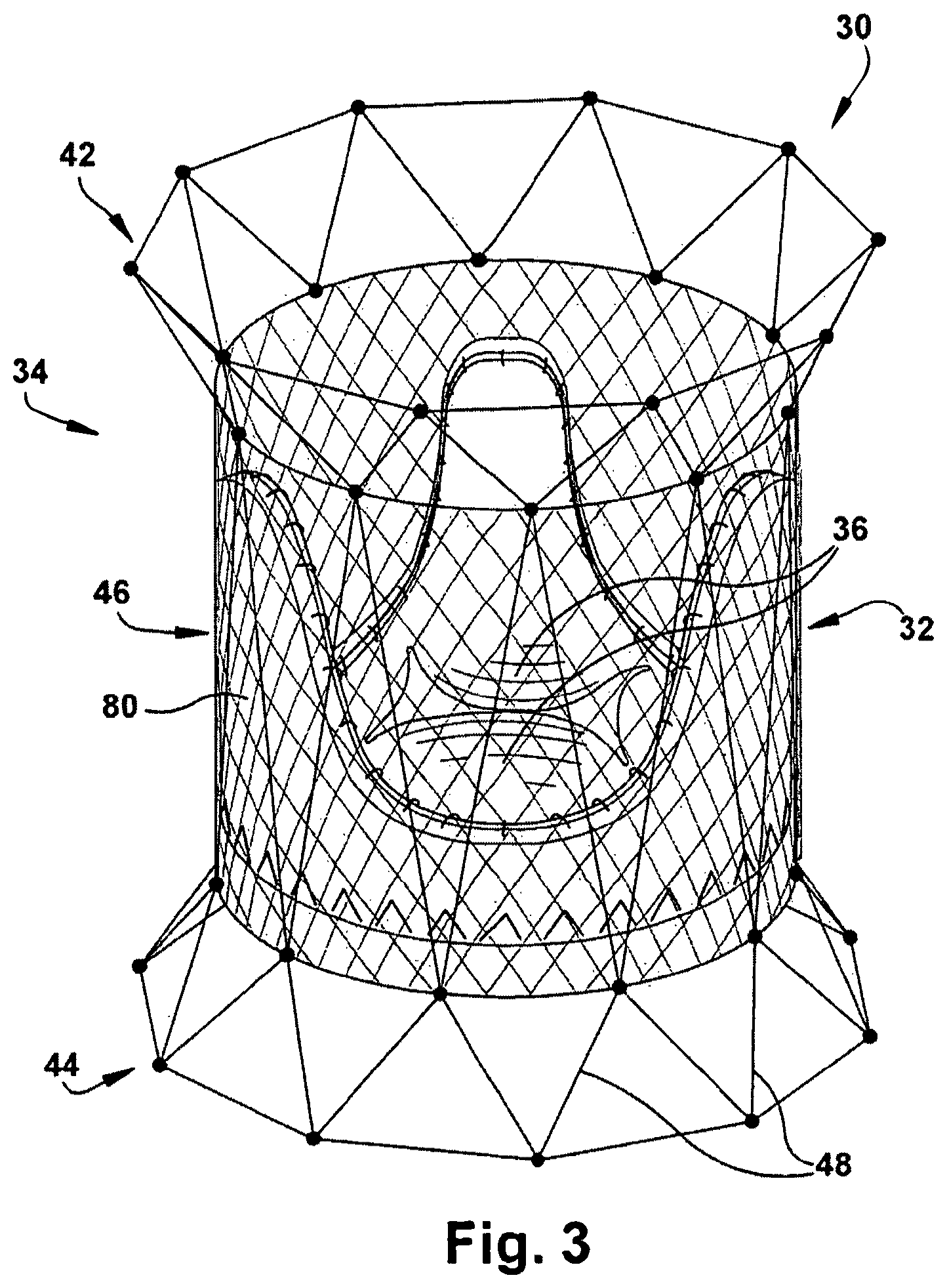 Patent US12318291 Figure 3 – Method for implanting a cardiovascular valve