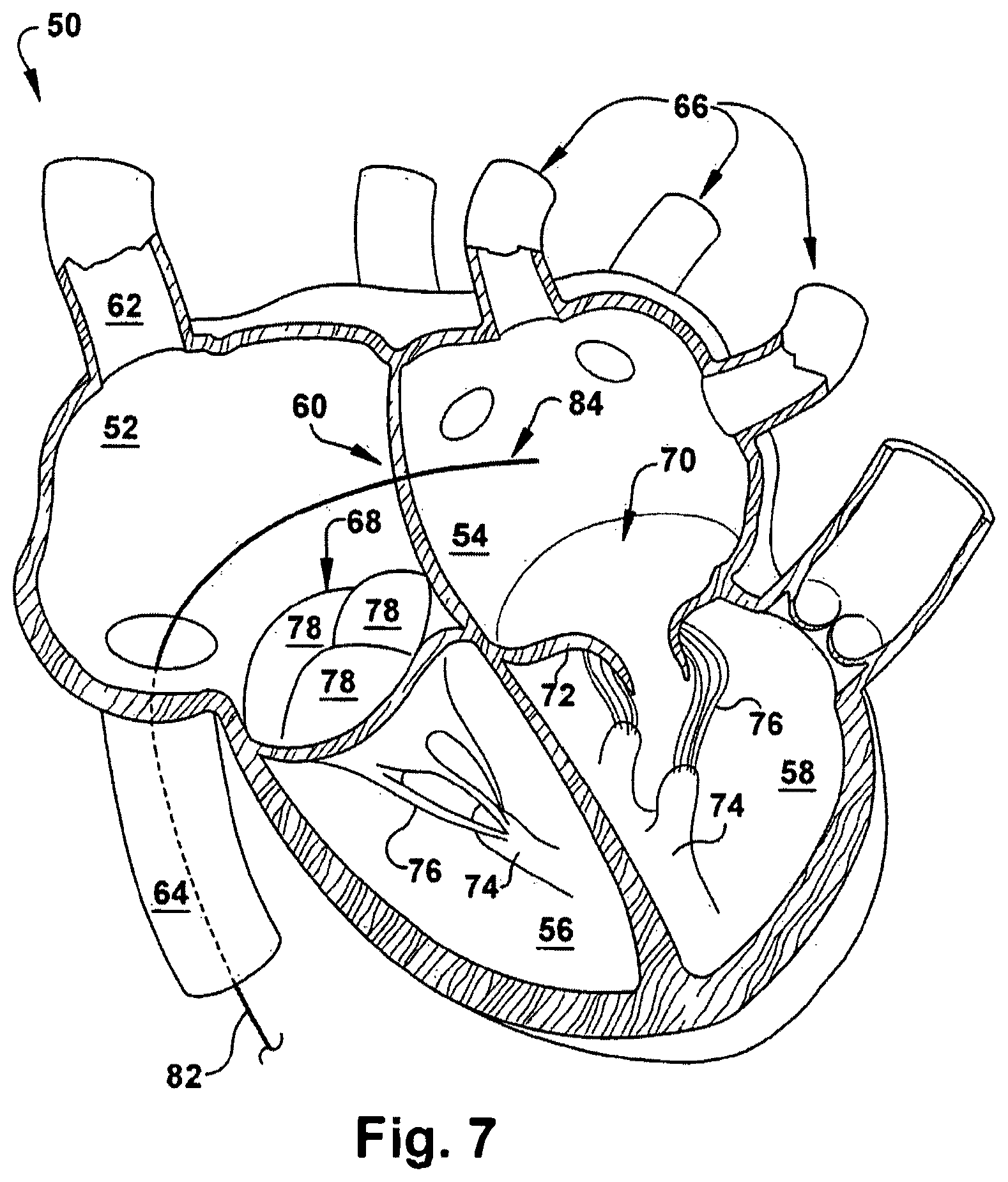 Patent US12318291 Figure 7 – Method for implanting a cardiovascular valve
