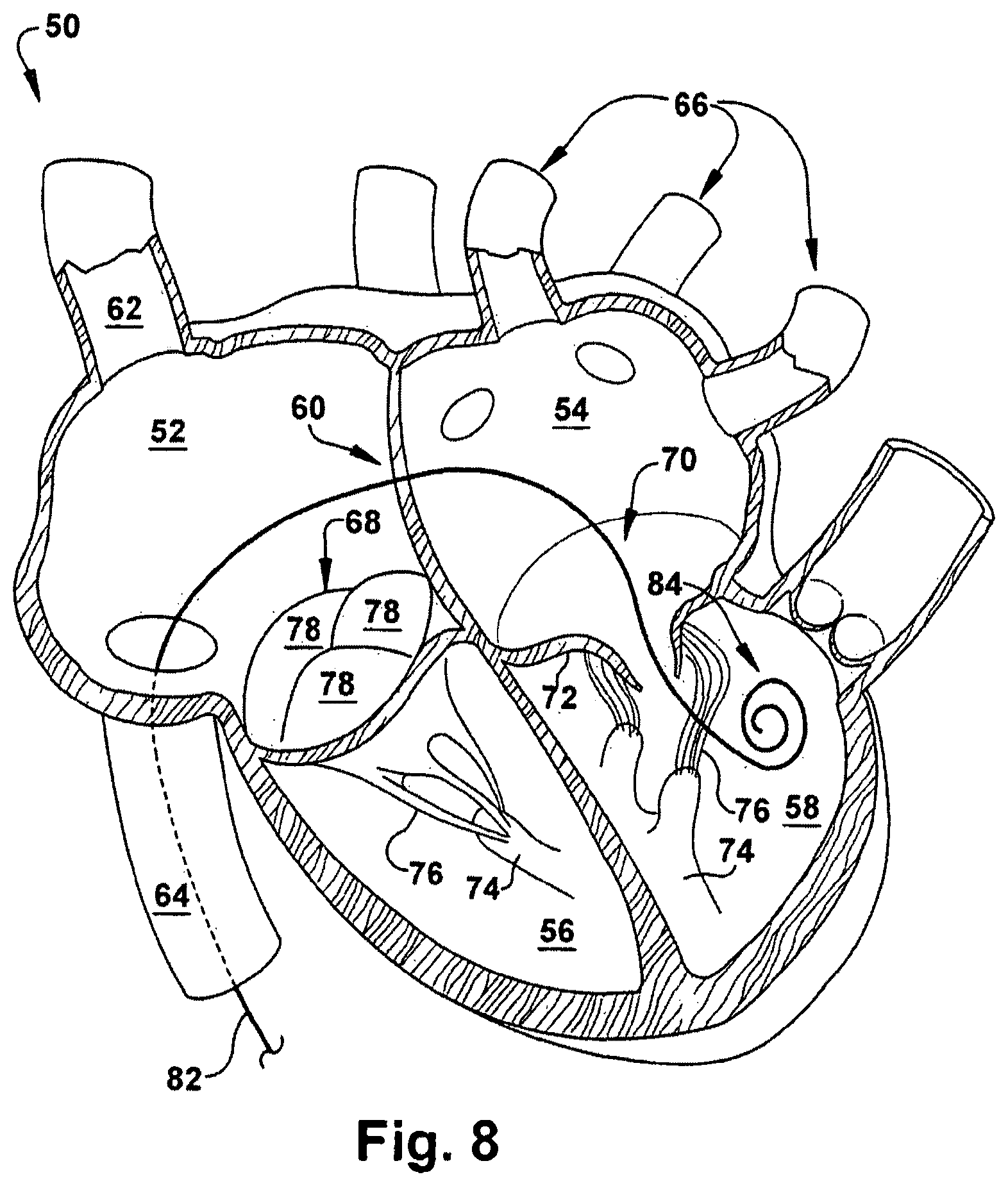 Patent US12318291 Figure 8 – Method for implanting a cardiovascular valve