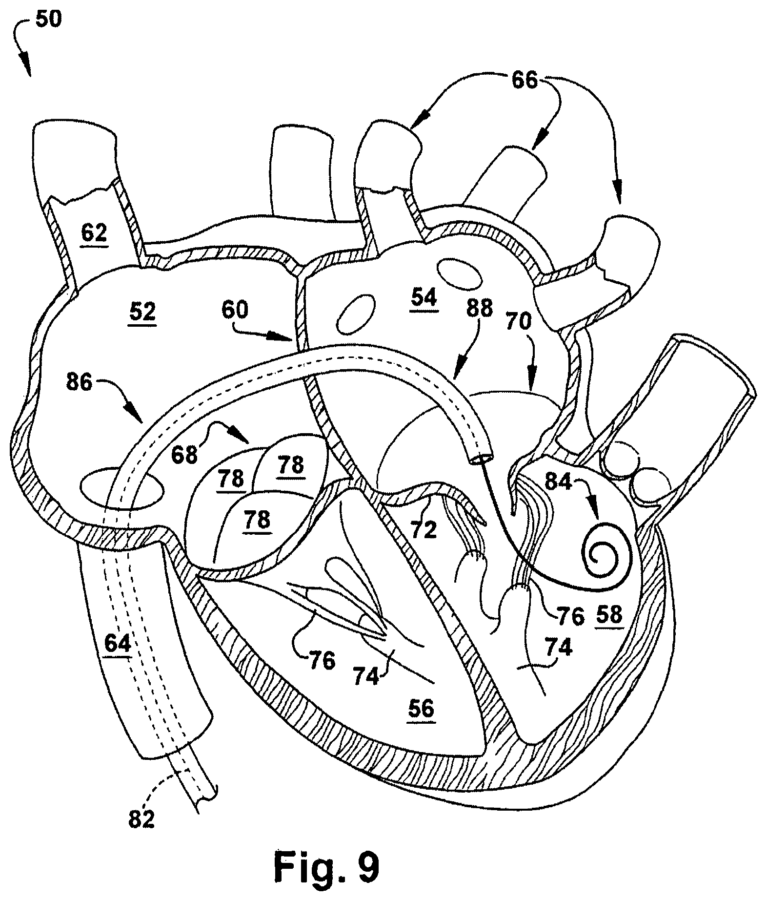 Patent US12318291 Figure 9 – Method for implanting a cardiovascular valve