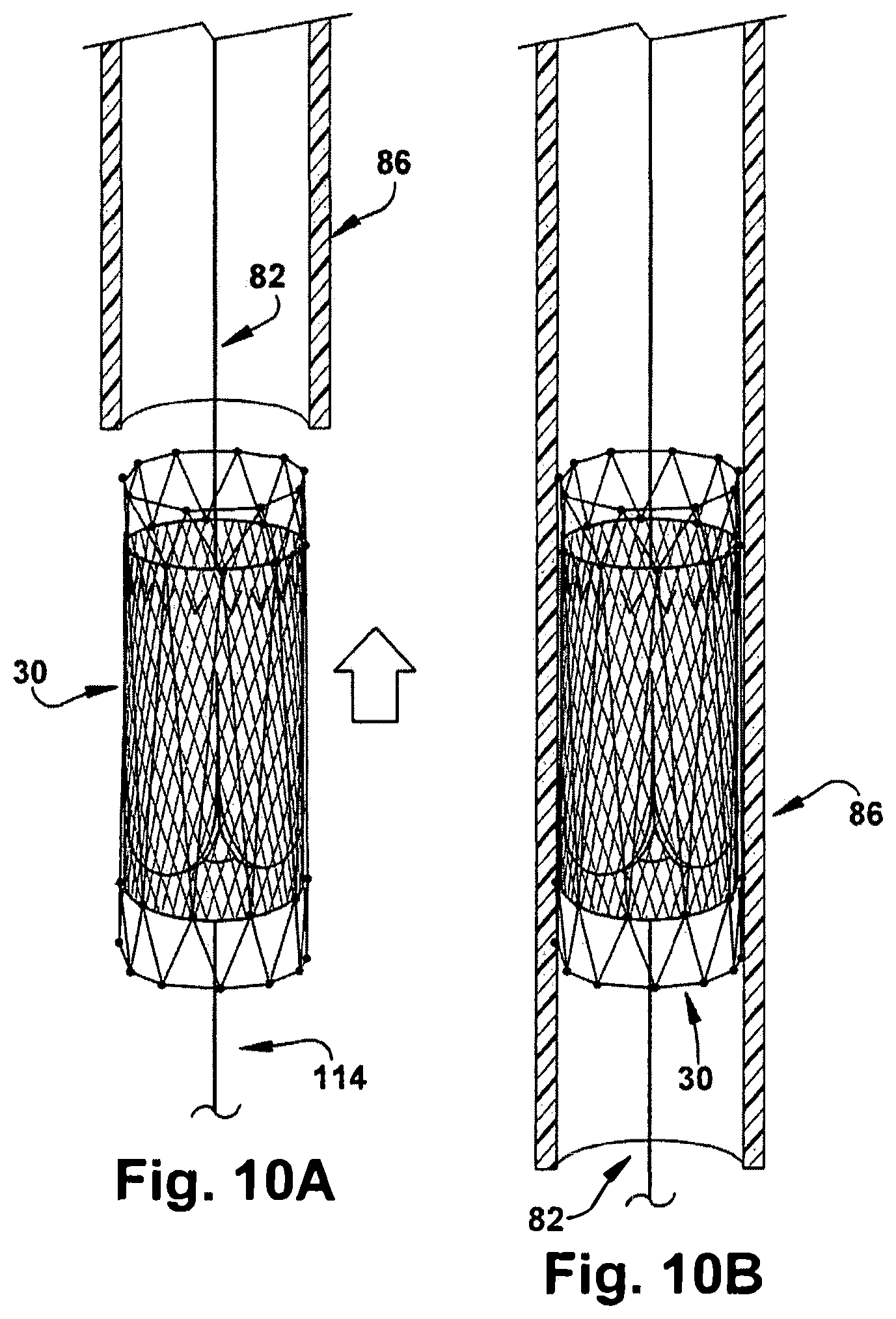 Patent US12318291 Figure 10 – Method for implanting a cardiovascular valve