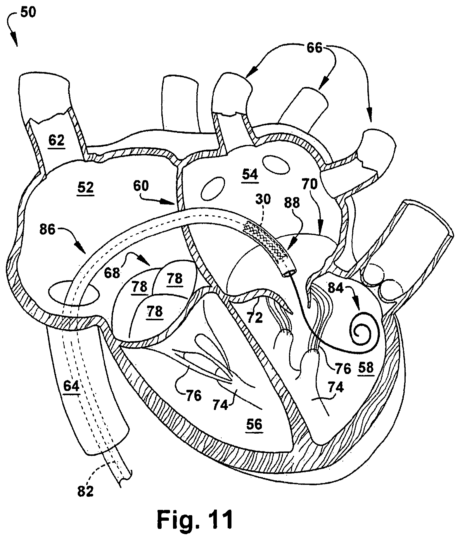 Patent US12318291 Figure 11 – Method for implanting a cardiovascular valve