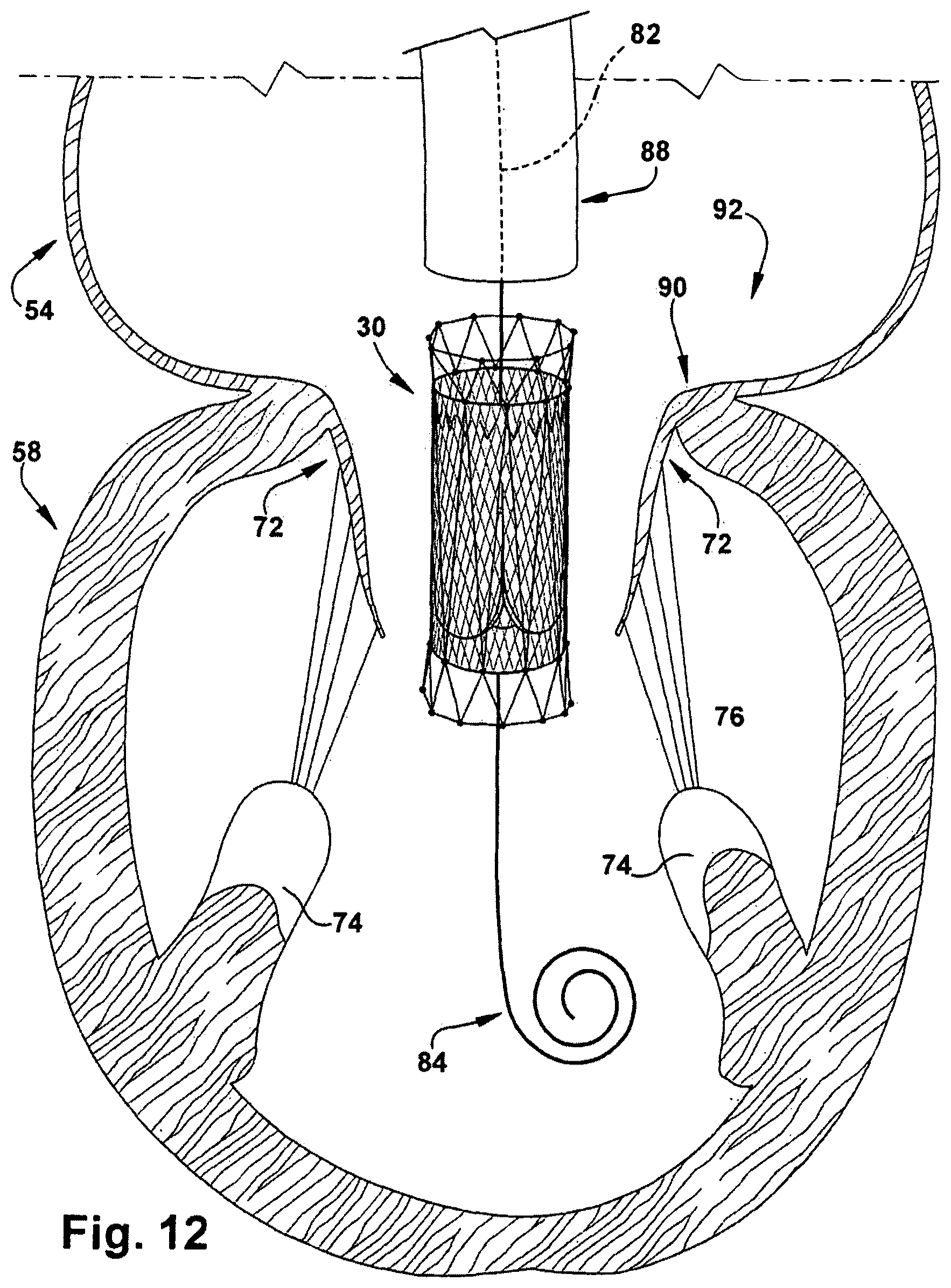 Patent US12318291 Figure 12 – Method for implanting a cardiovascular valve