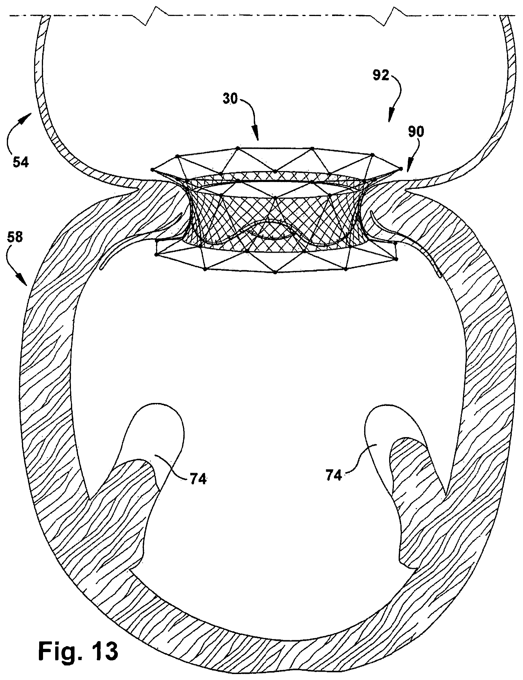 Patent US12318291 Figure 13 – Method for implanting a cardiovascular valve