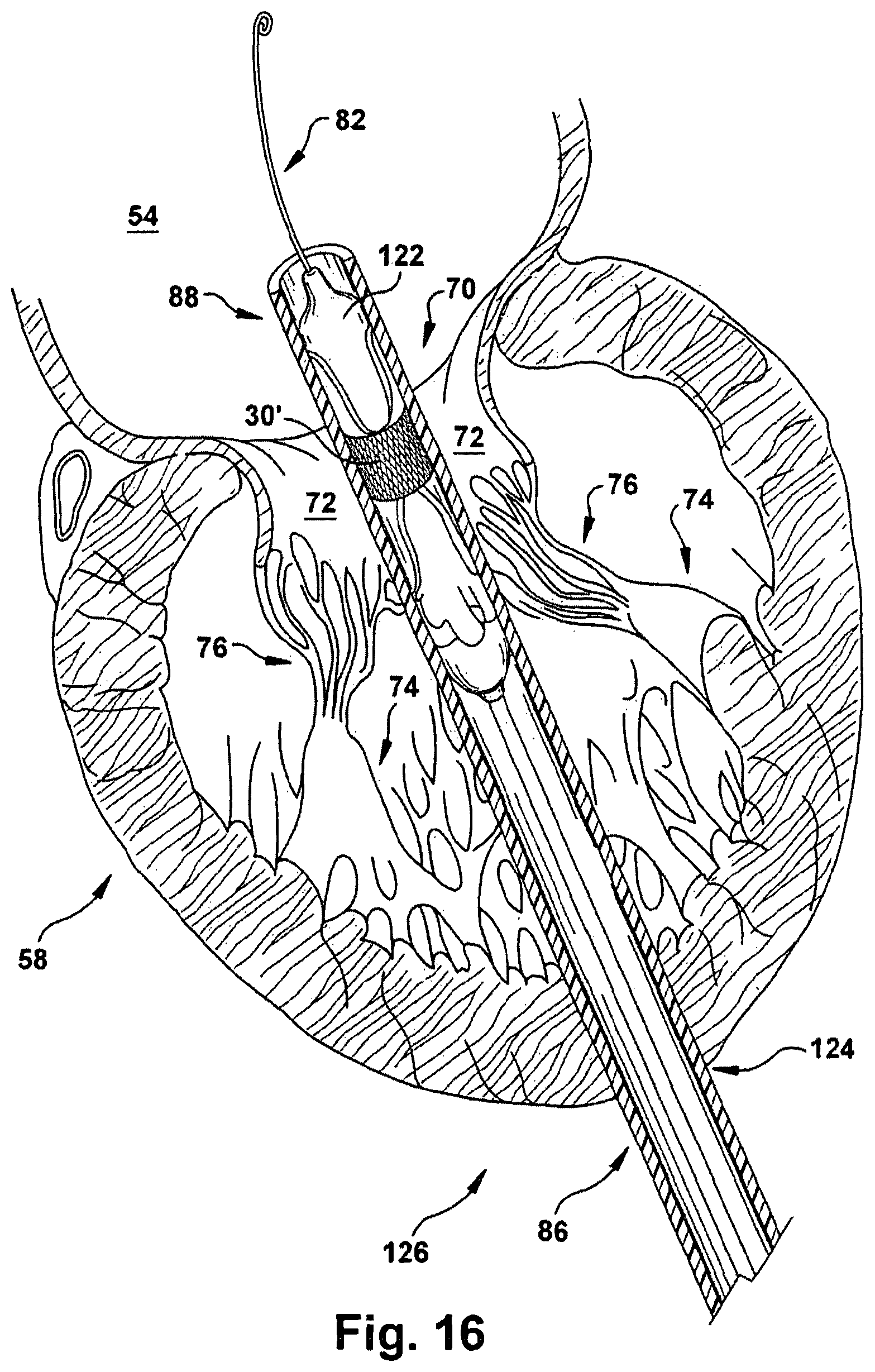 Patent US12318291 Figure 16 – Method for implanting a cardiovascular valve