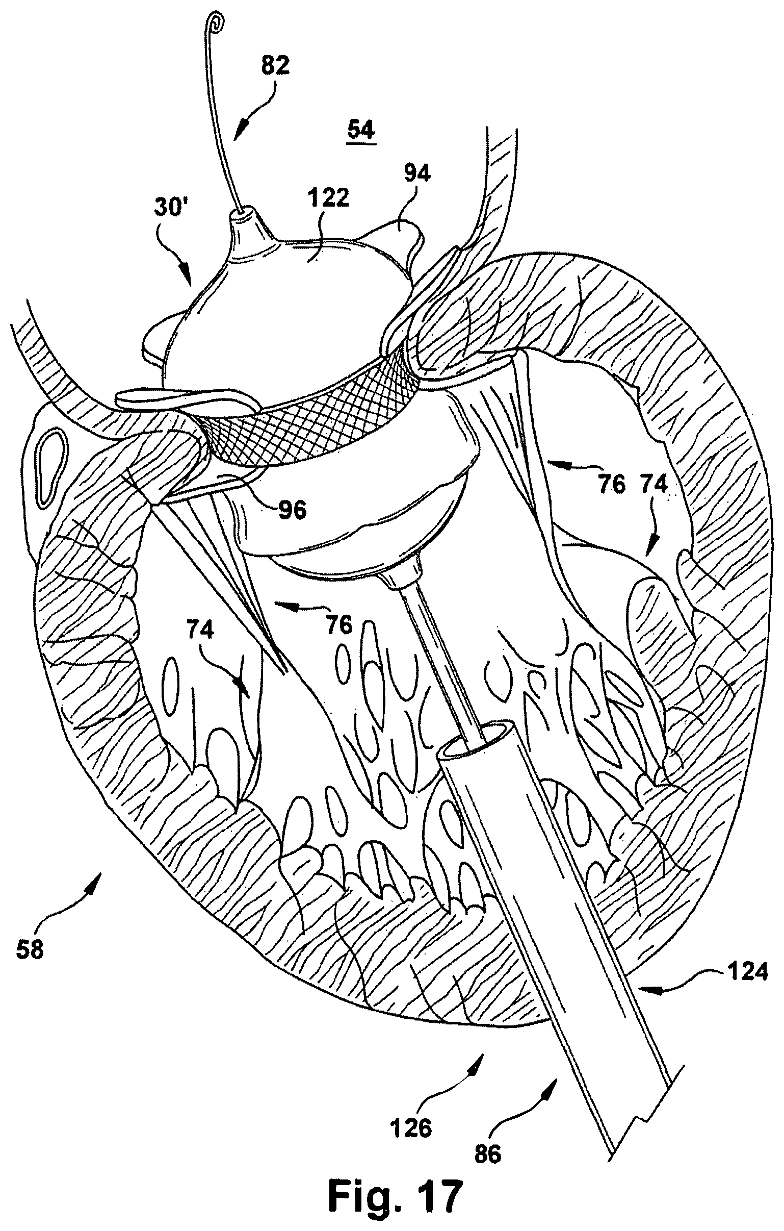 Patent US12318291 Figure 17 – Method for implanting a cardiovascular valve