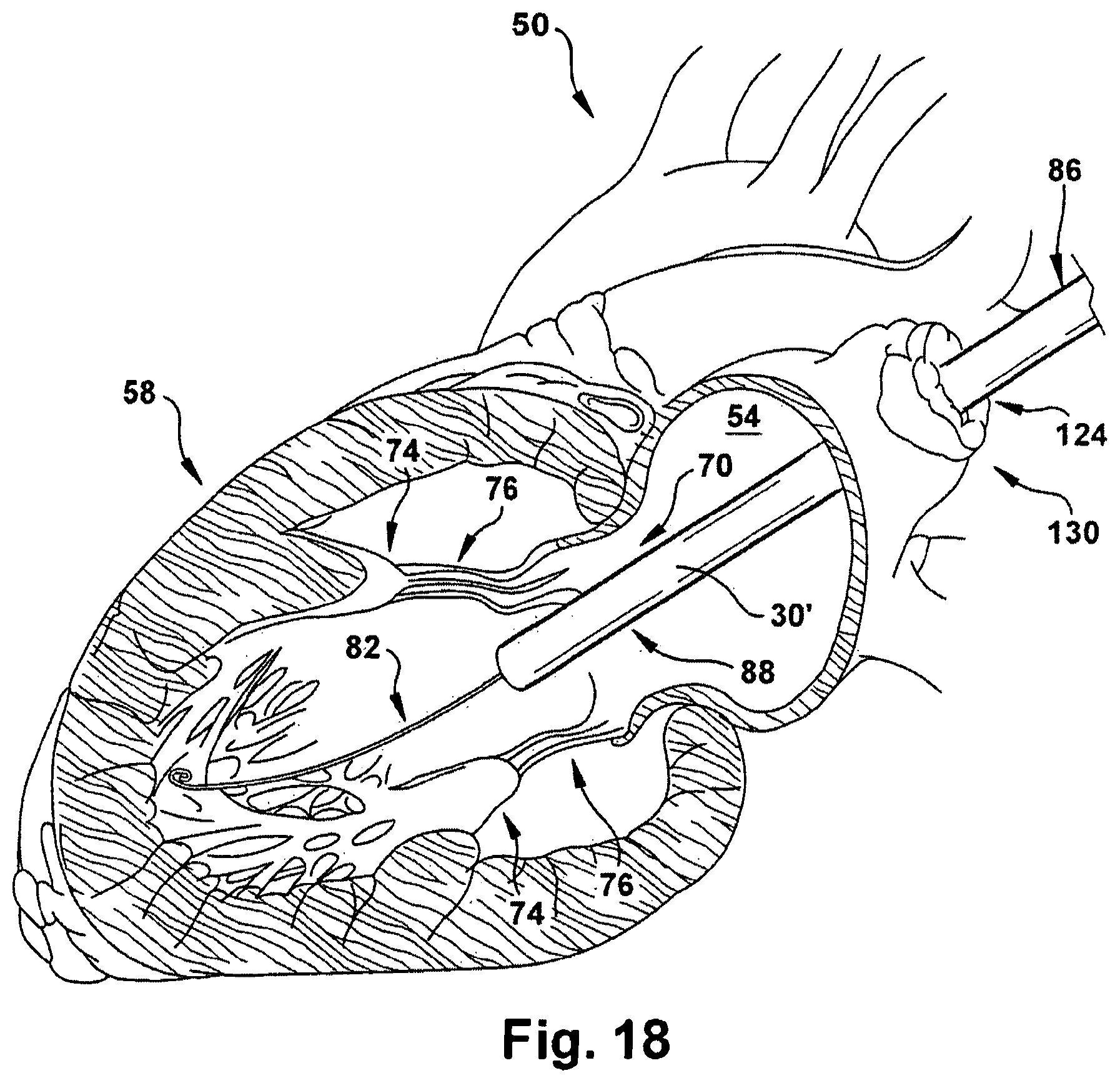 Patent US12318291 Figure 18 – Method for implanting a cardiovascular valve