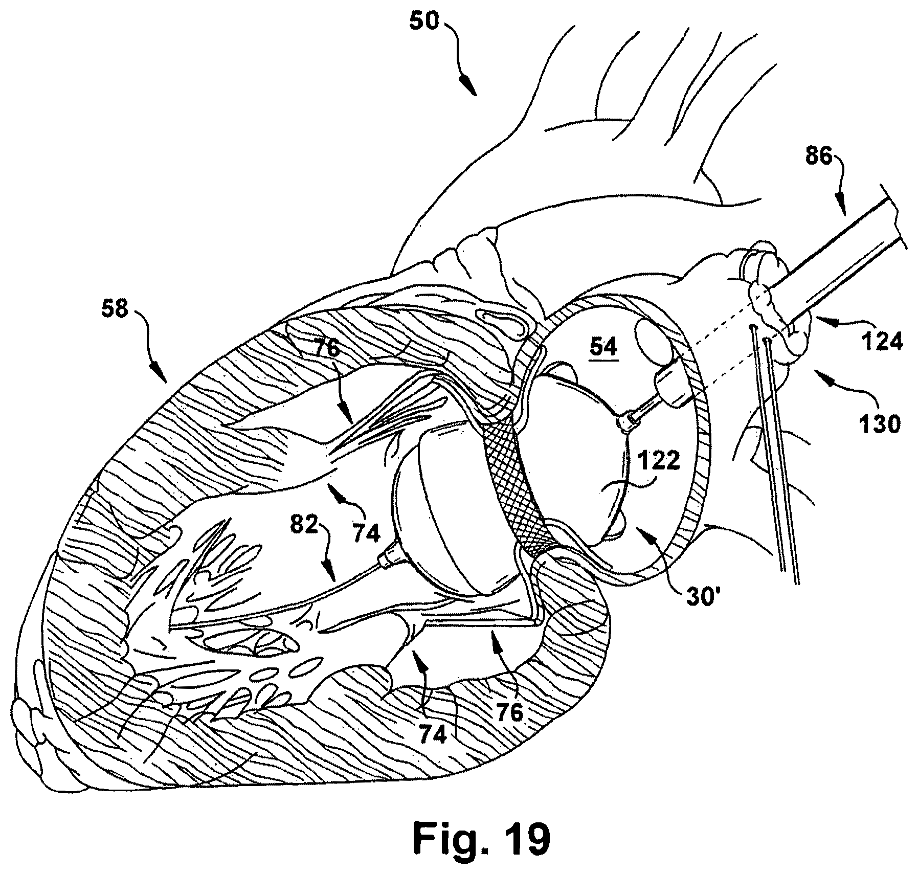 Patent US12318291 Figure 19 – Method for implanting a cardiovascular valve