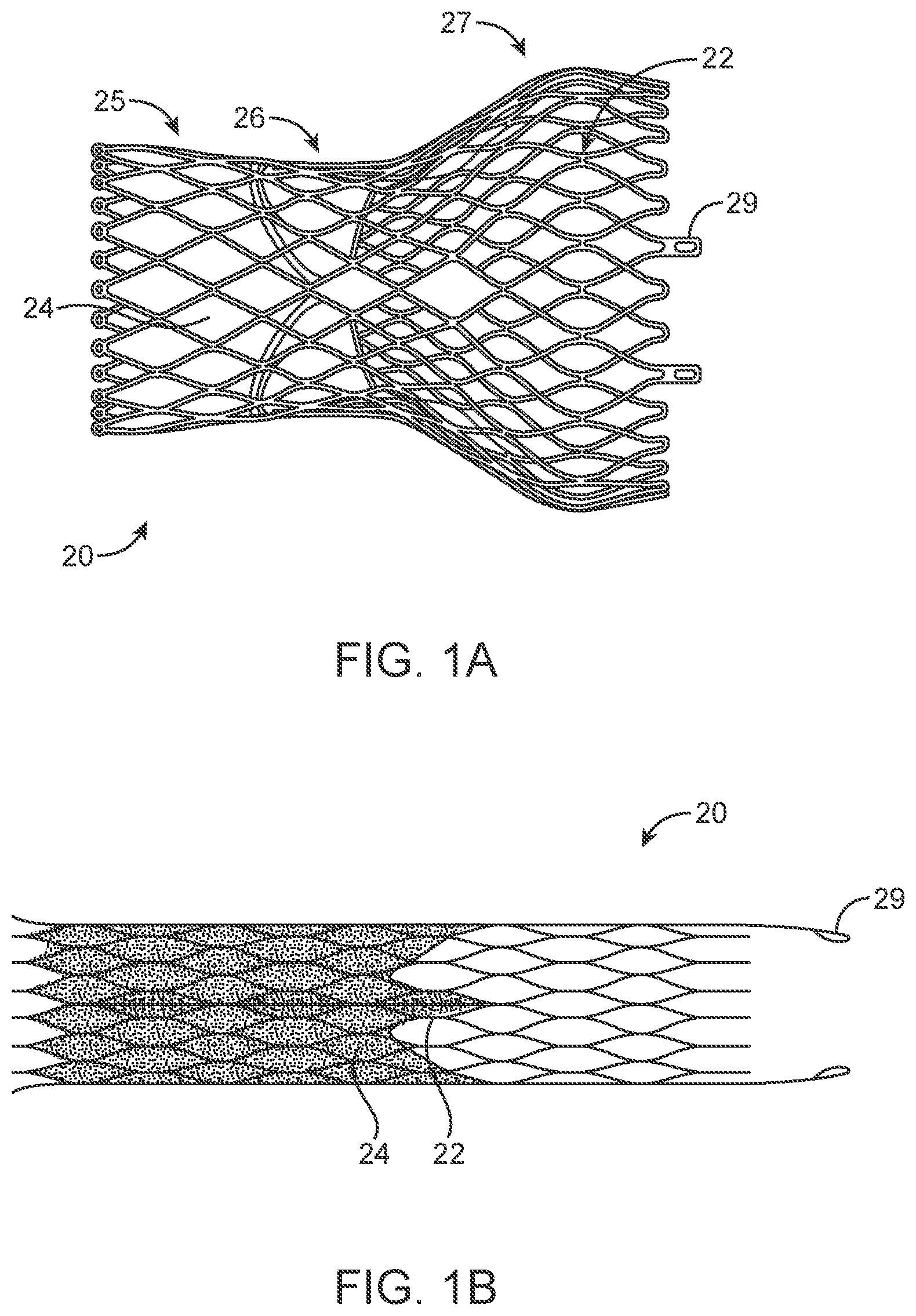 Patent US12318293 Figure 1 – System and method of stepped deployment of prosthetic heart valve