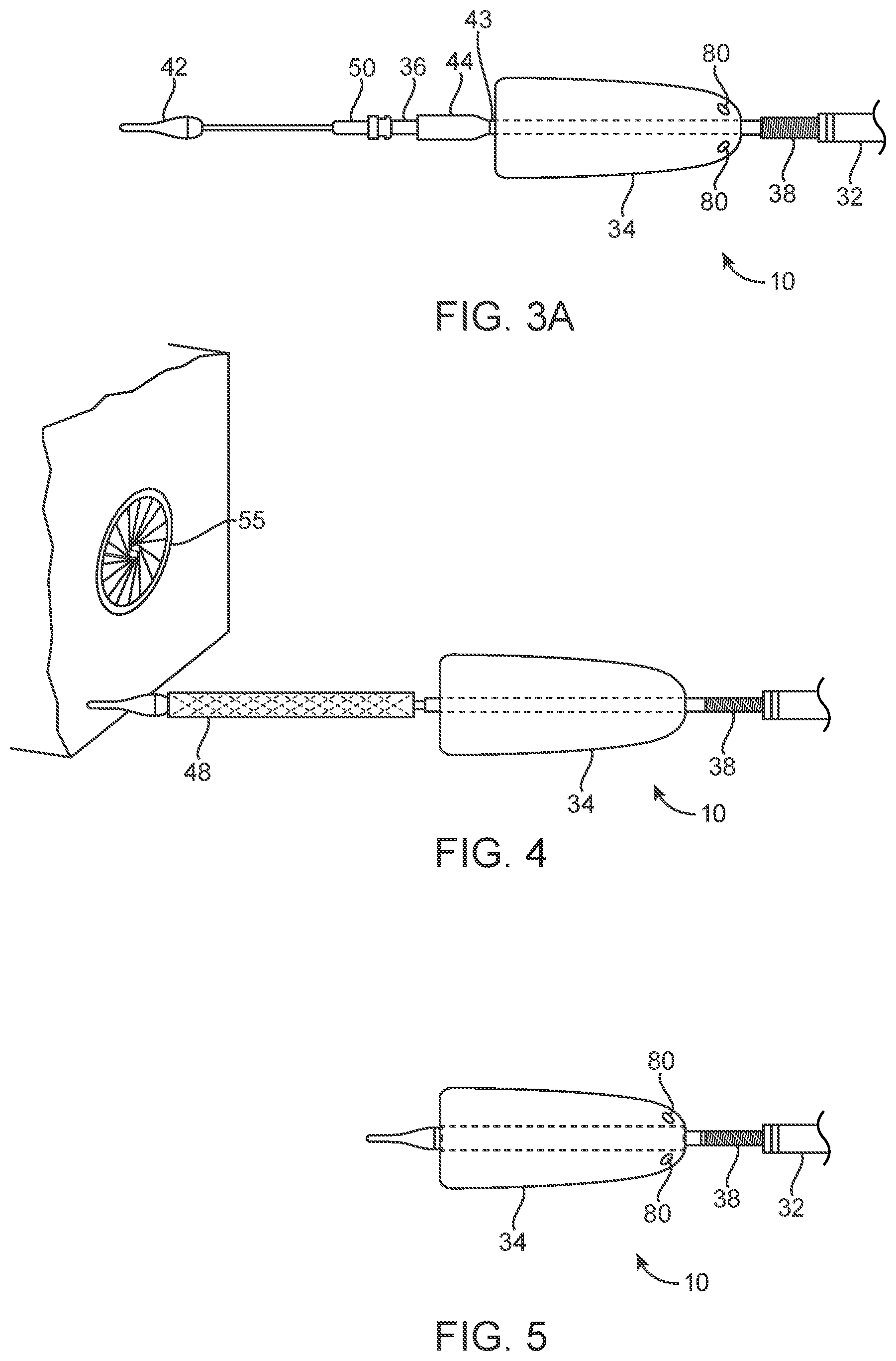 Patent US12318293 Figure 3 – System and method of stepped deployment of prosthetic heart valve