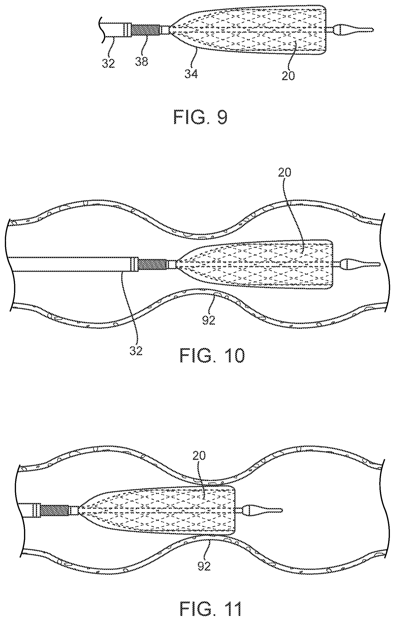 Patent US12318293 Figure 6 – System and method of stepped deployment of prosthetic heart valve