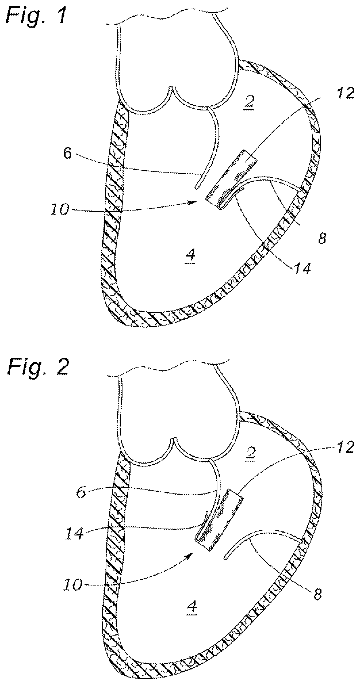 Patent US12318294 Figure 1 – Tissue grasping devices and related methods
