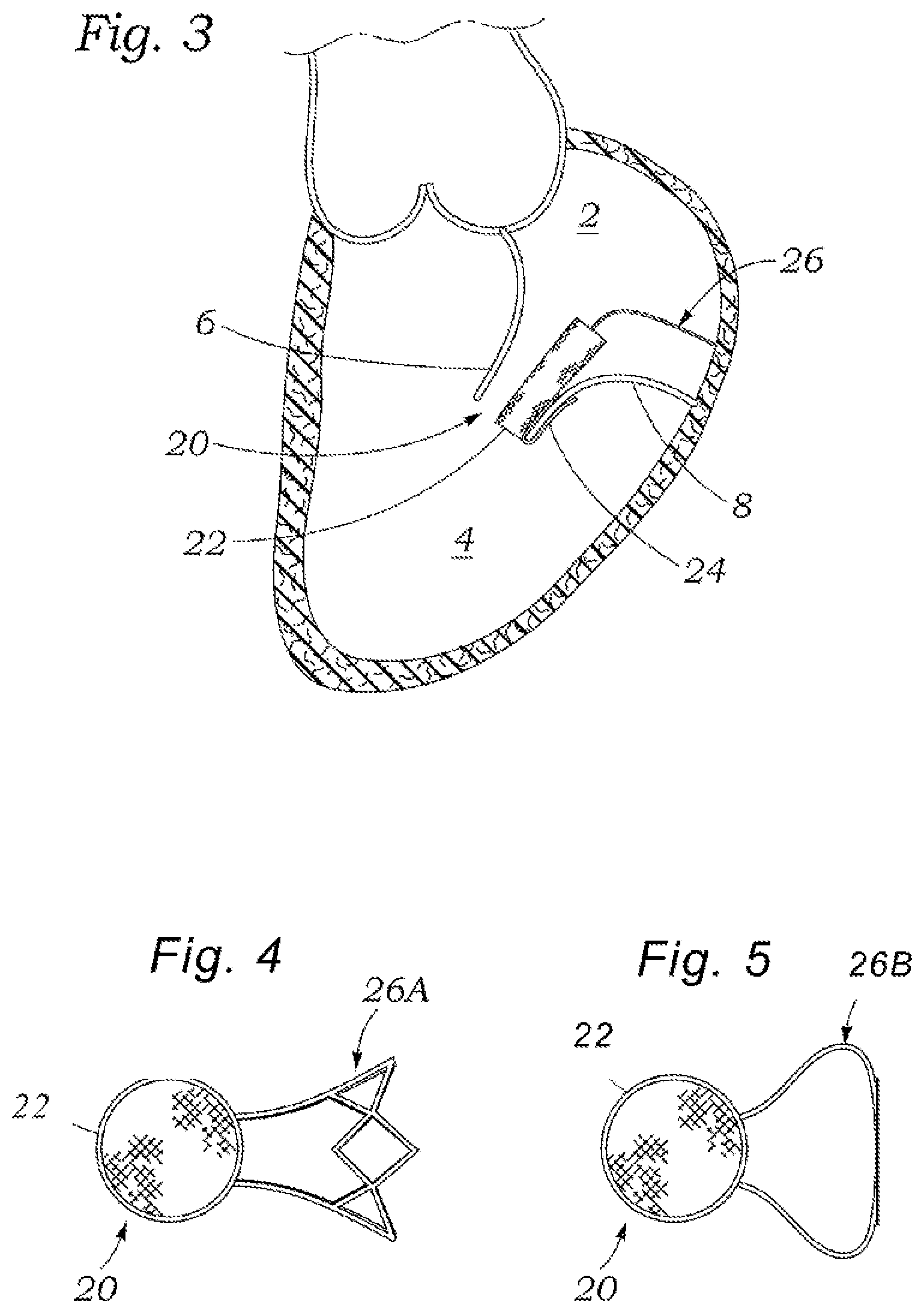 Patent US12318294 Figure 2 – Tissue grasping devices and related methods