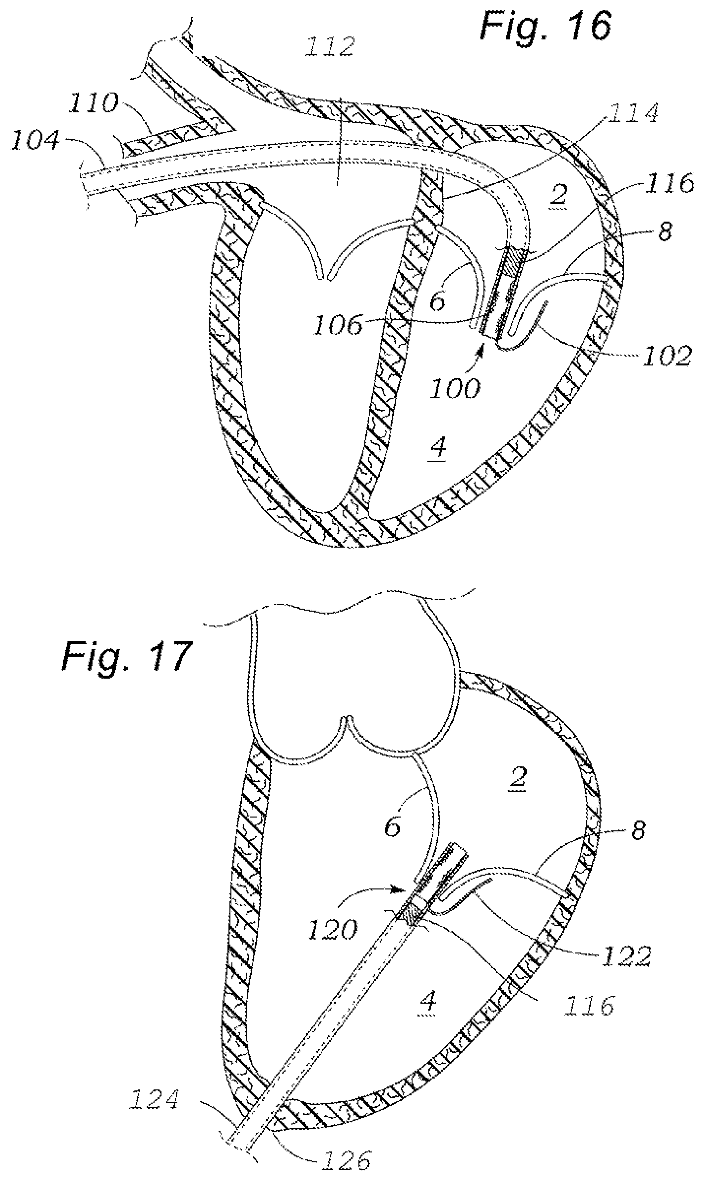 Patent US12318294 Figure 7 – Tissue grasping devices and related methods
