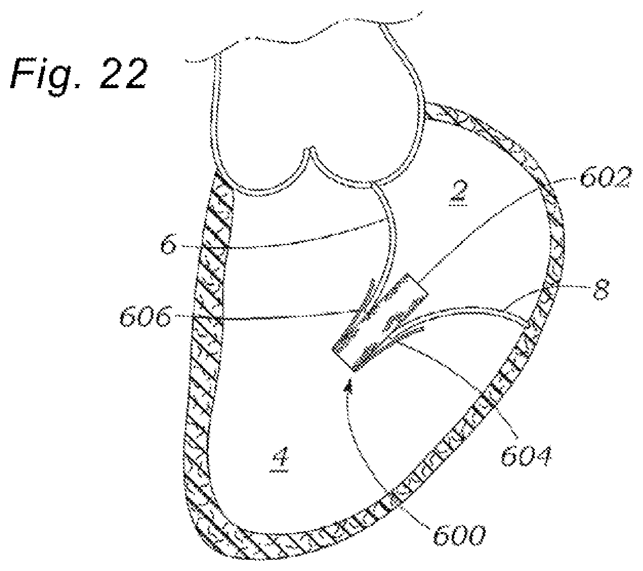 Patent US12318294 Figure 9 – Tissue grasping devices and related methods