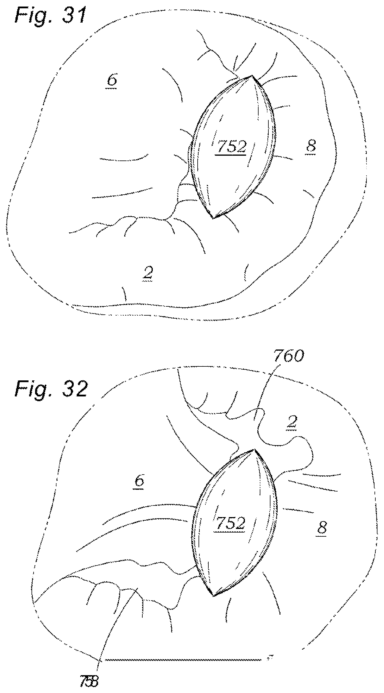 Patent US12318294 Figure 12 – Tissue grasping devices and related methods