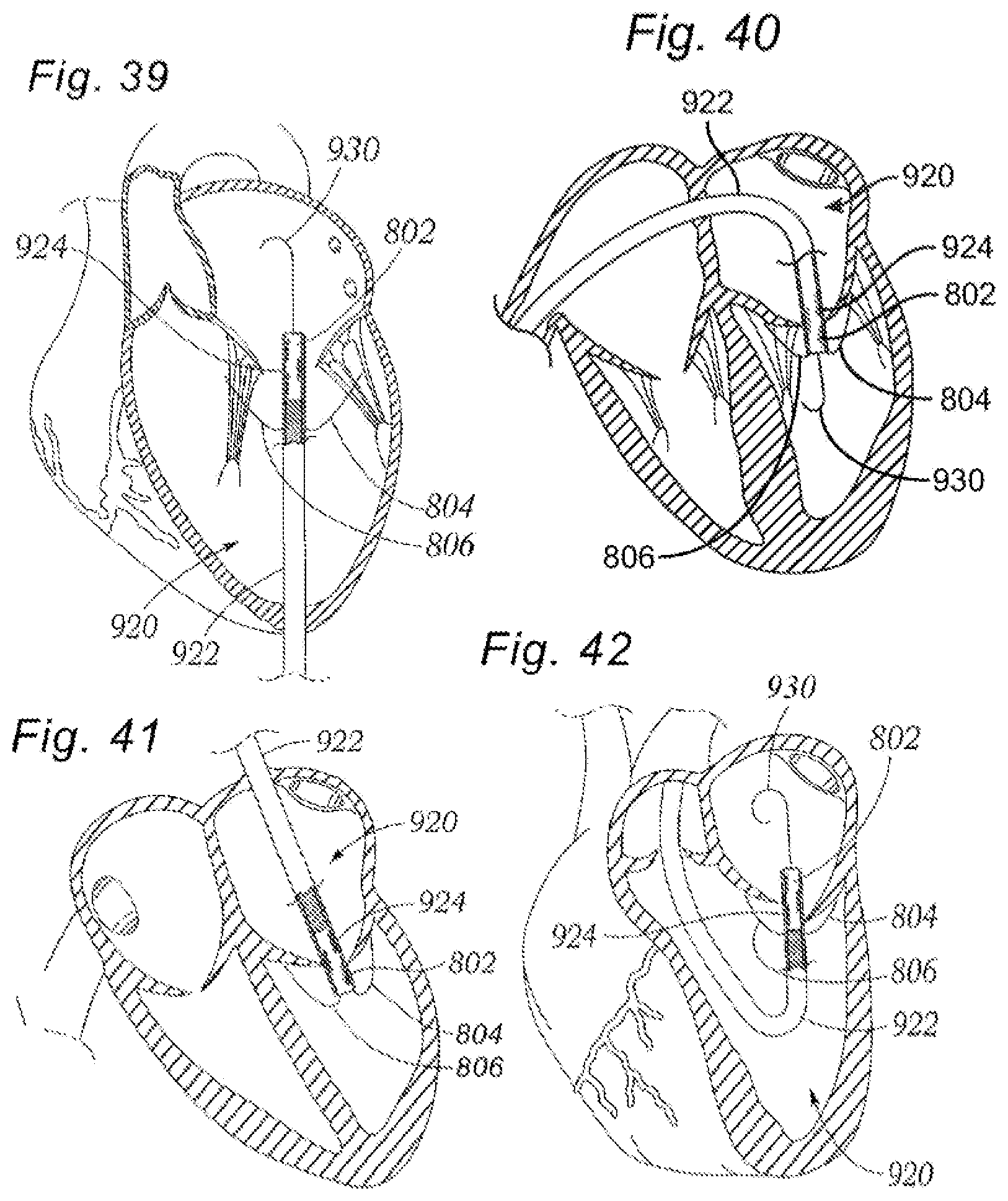 Patent US12318294 Figure 16 – Tissue grasping devices and related methods
