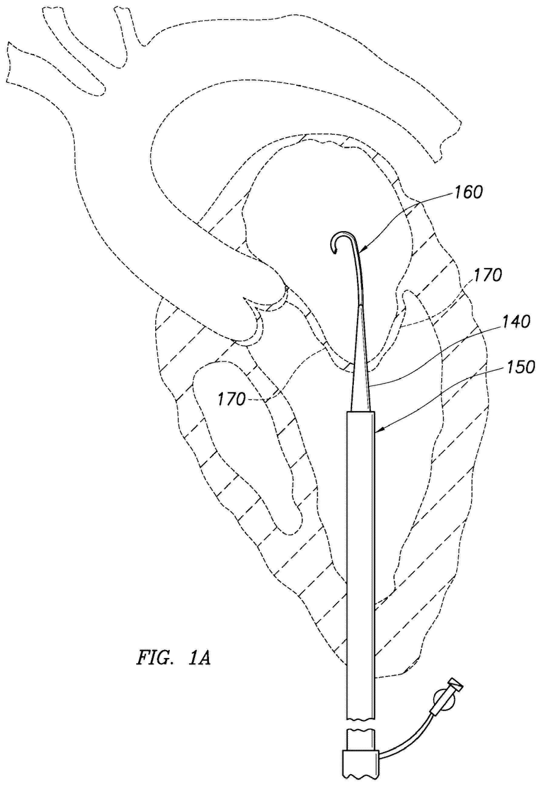 Patent US12318295 Figure 1 – Cardiac prosthesis