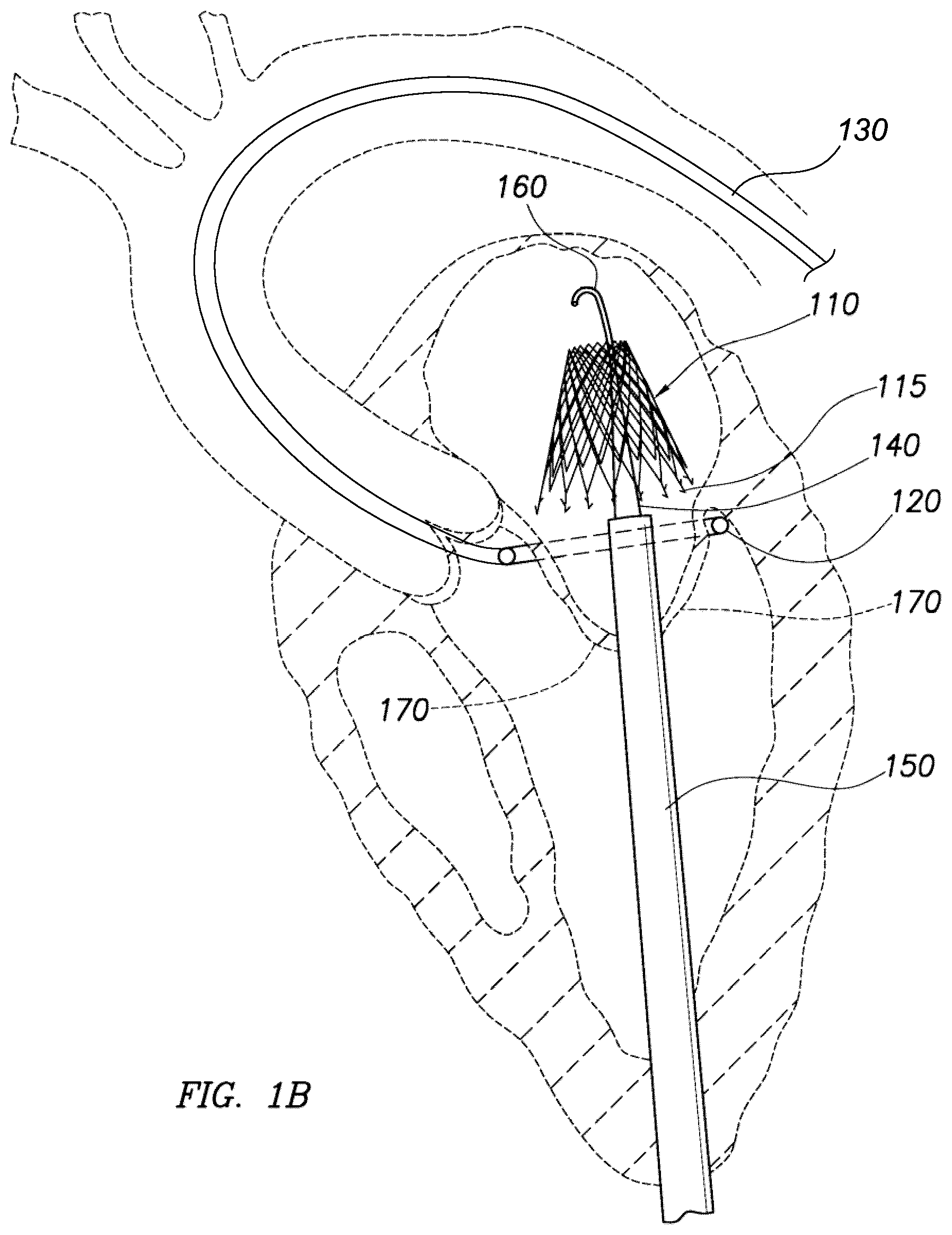 Patent US12318295 Figure 2 – Cardiac prosthesis