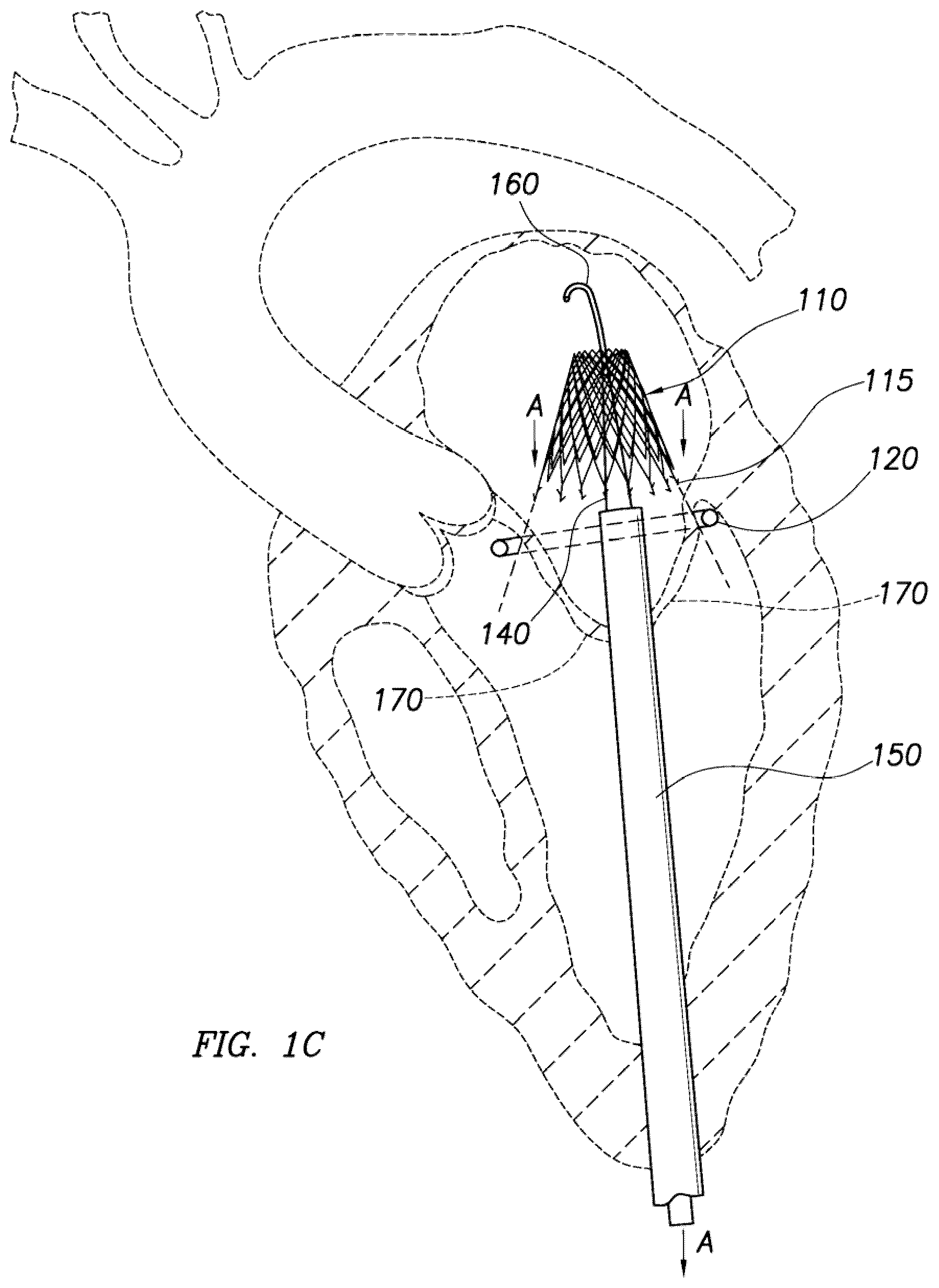 Patent US12318295 Figure 3 – Cardiac prosthesis