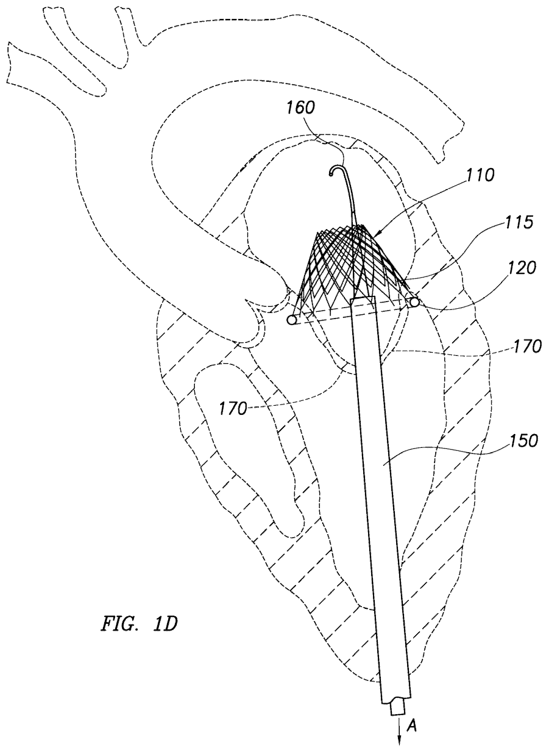 Patent US12318295 Figure 4 – Cardiac prosthesis