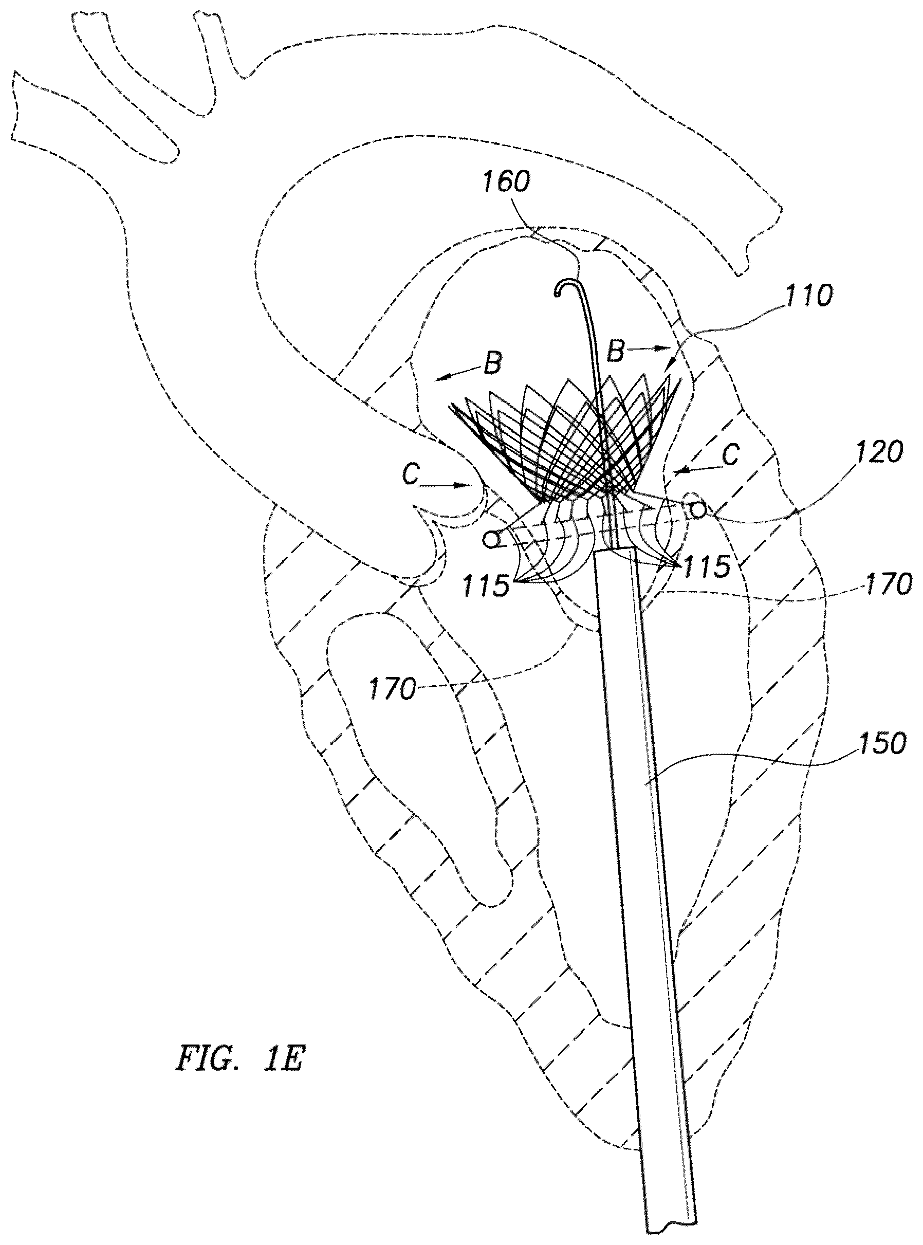 Patent US12318295 Figure 5 – Cardiac prosthesis