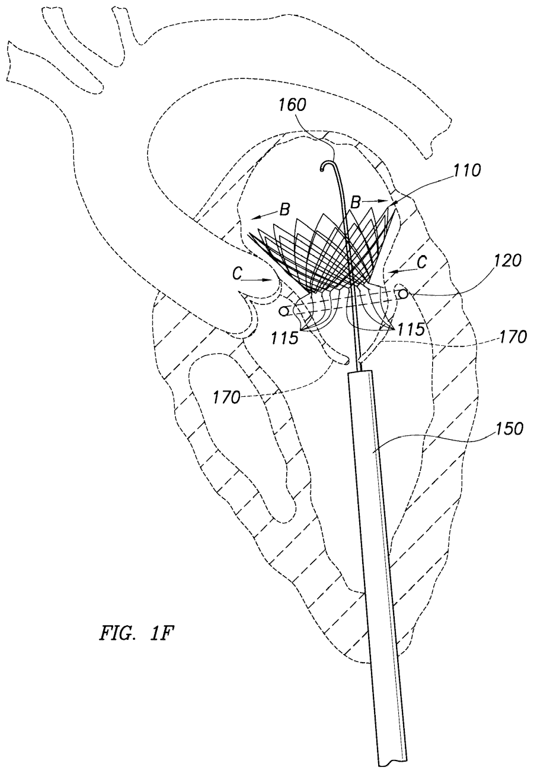 Patent US12318295 Figure 6 – Cardiac prosthesis
