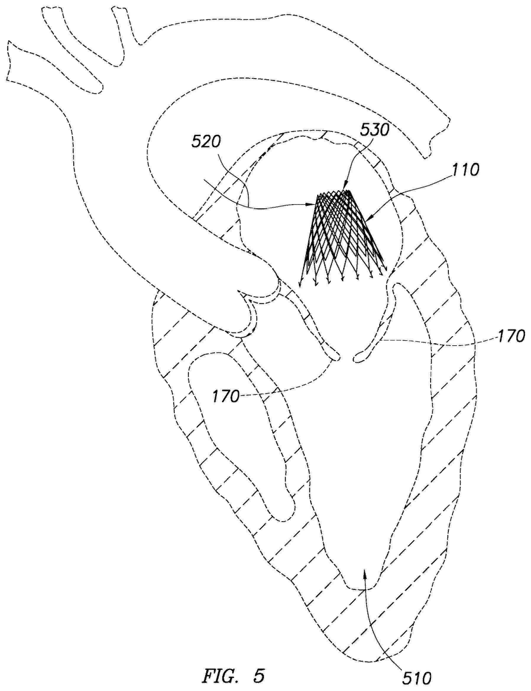 Patent US12318295 Figure 11 – Cardiac prosthesis
