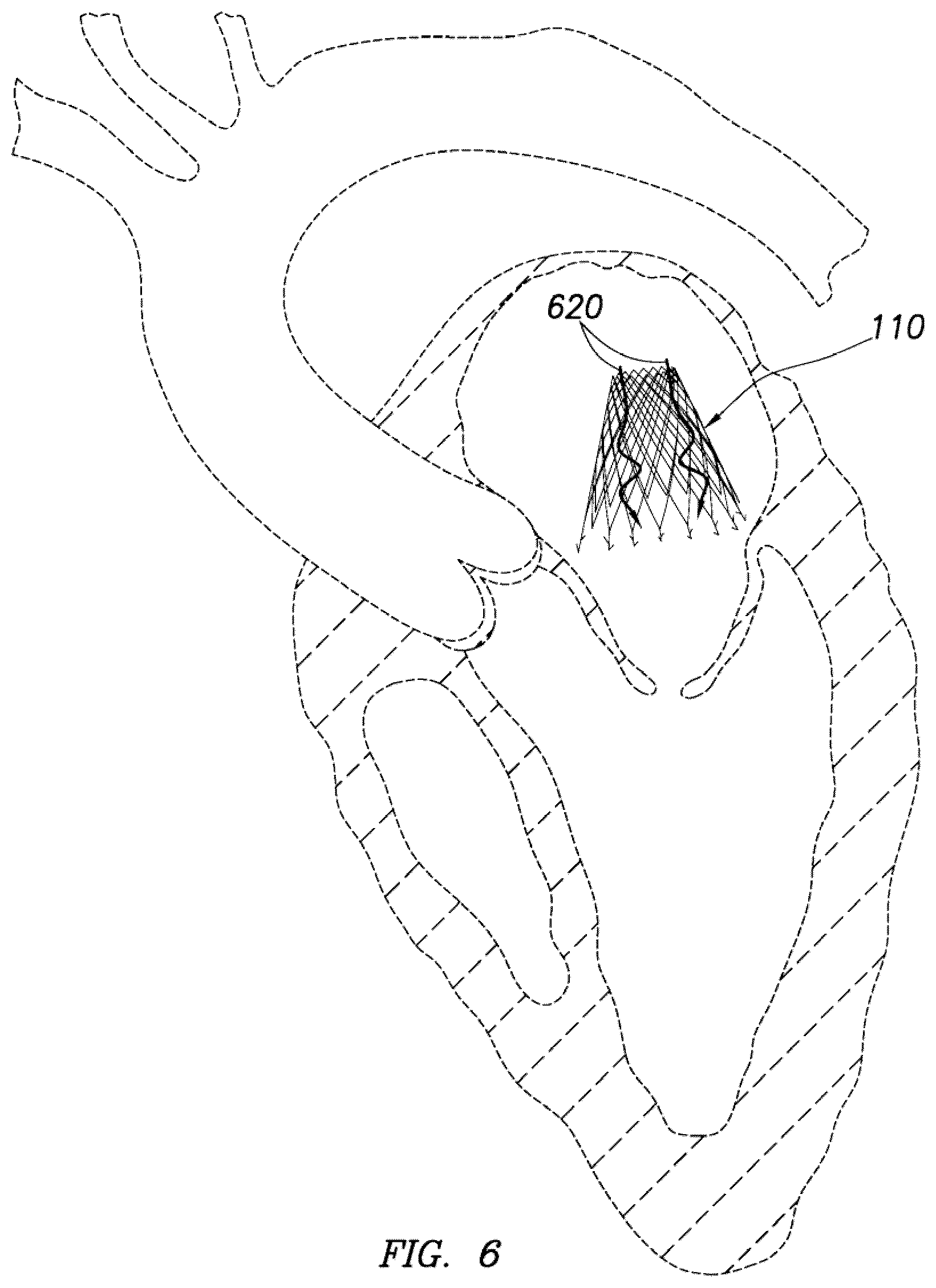 Patent US12318295 Figure 12 – Cardiac prosthesis
