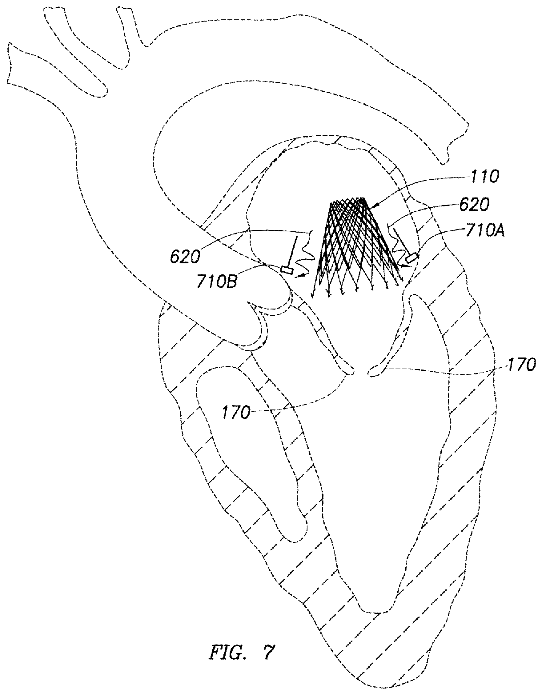 Patent US12318295 Figure 13 – Cardiac prosthesis