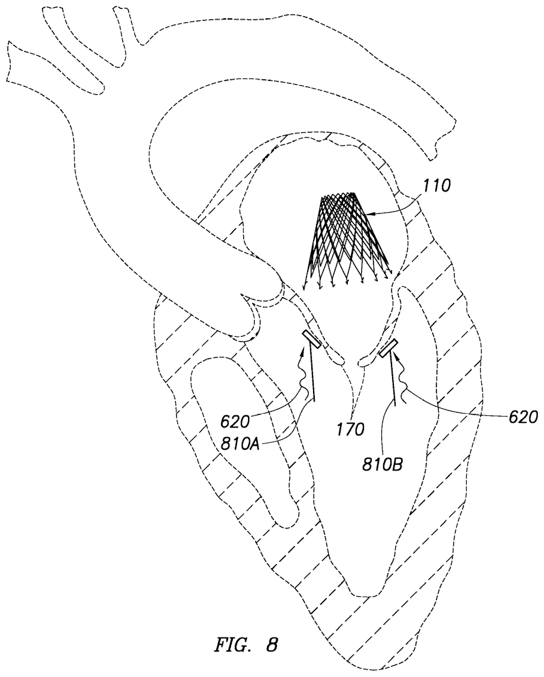 Patent US12318295 Figure 14 – Cardiac prosthesis