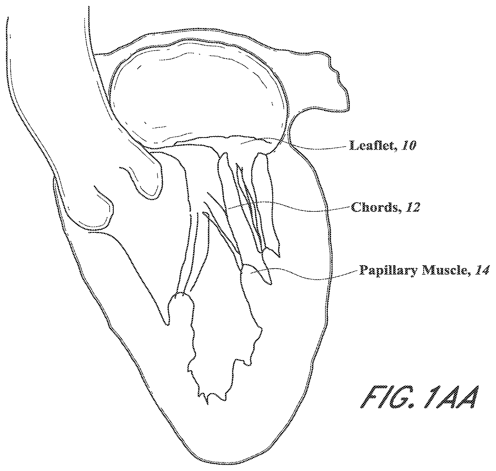 Patent US12318296 Figure 1 – Mitral leaflet tethering